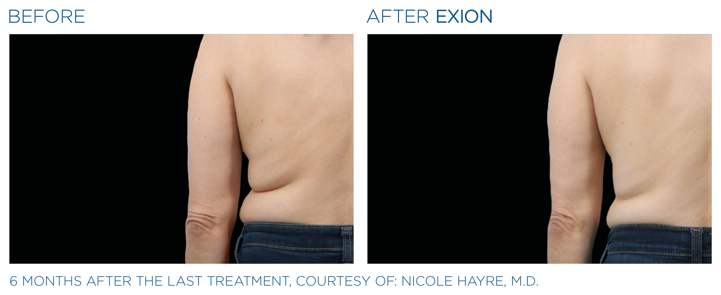Exion_PIC_Ba-card-back-female-036_Body_ENUS100.png
