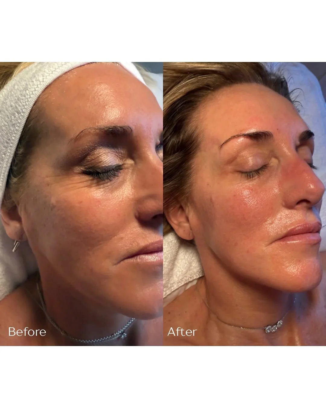 | WE LOVE RESULTS!! | 

Pictured pre and post after 12 sessions of aesthetic acupuncture, spaced about 1 week apart. Natural, healthy, confident. 💖

Although she had gorgeous skin to begin with, aesthetic acupuncture softened some fine lines near he