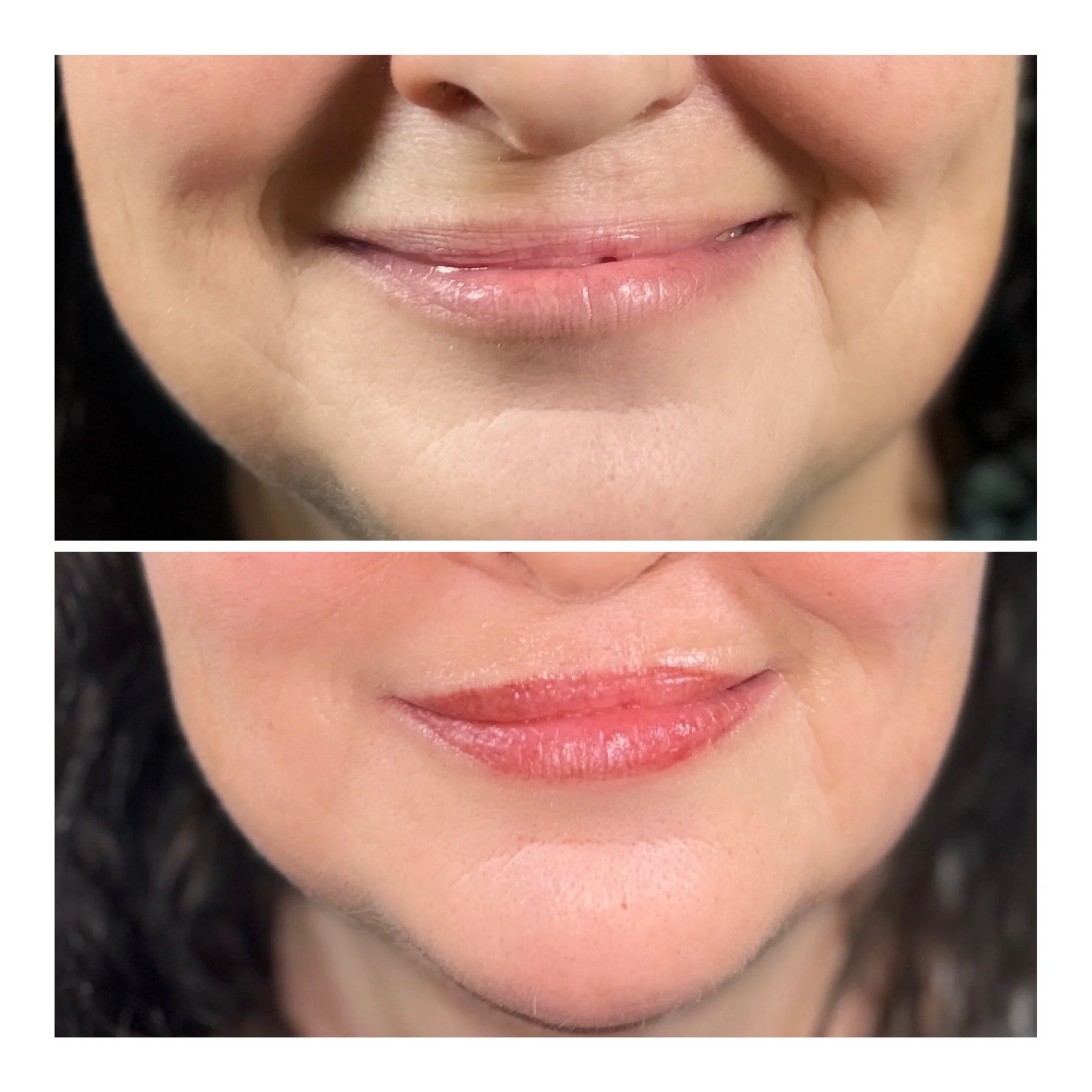Lips before & After 