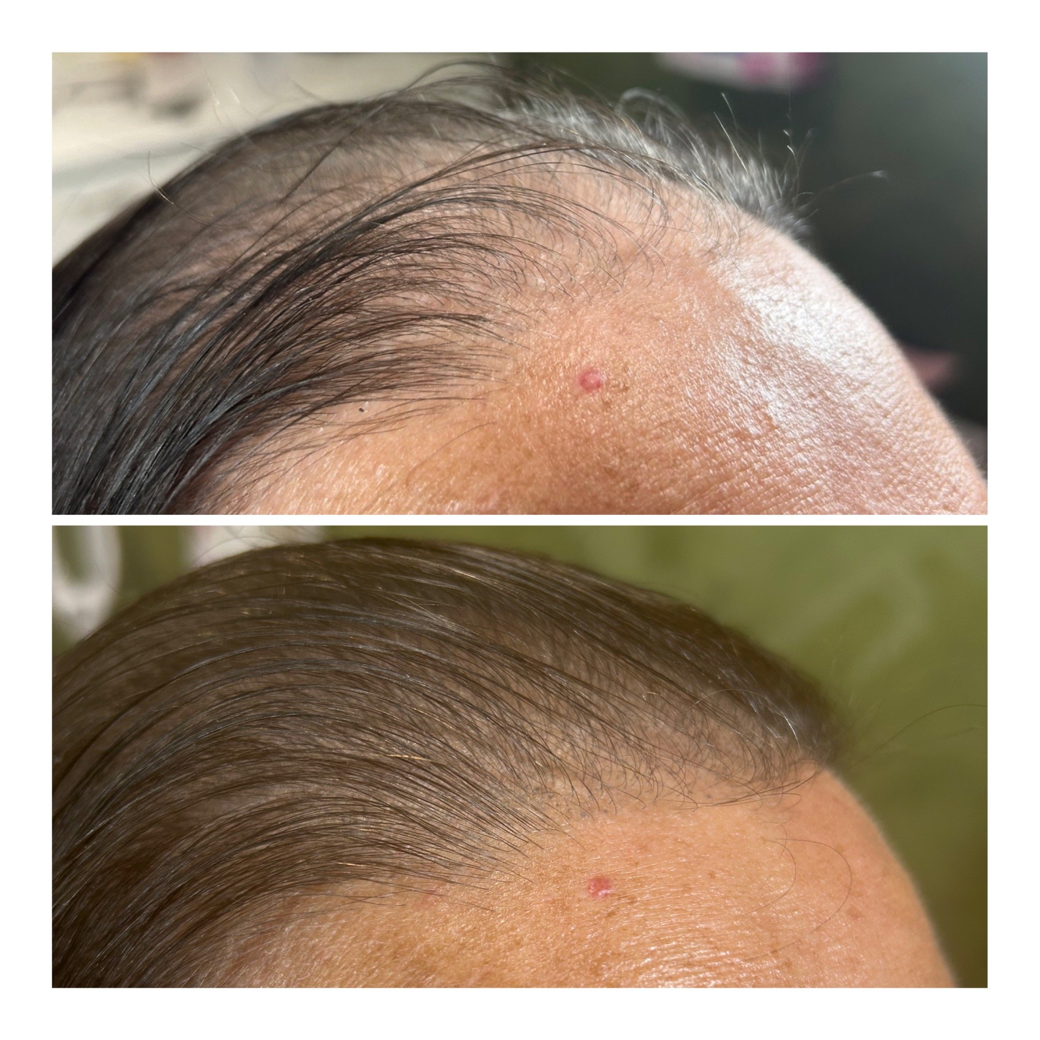 Before & After SMP Scalp Micropigmentation