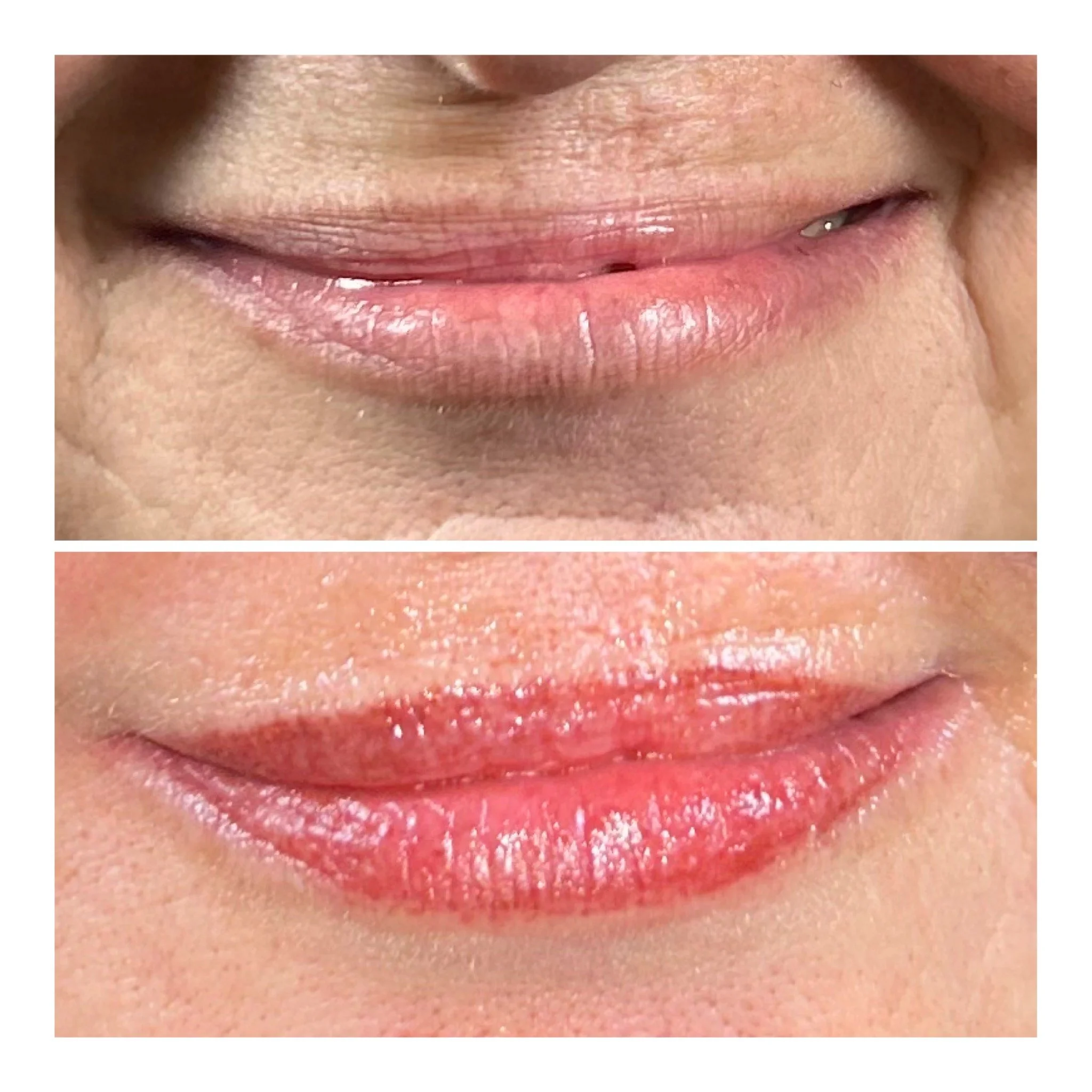 Lips Before & After 