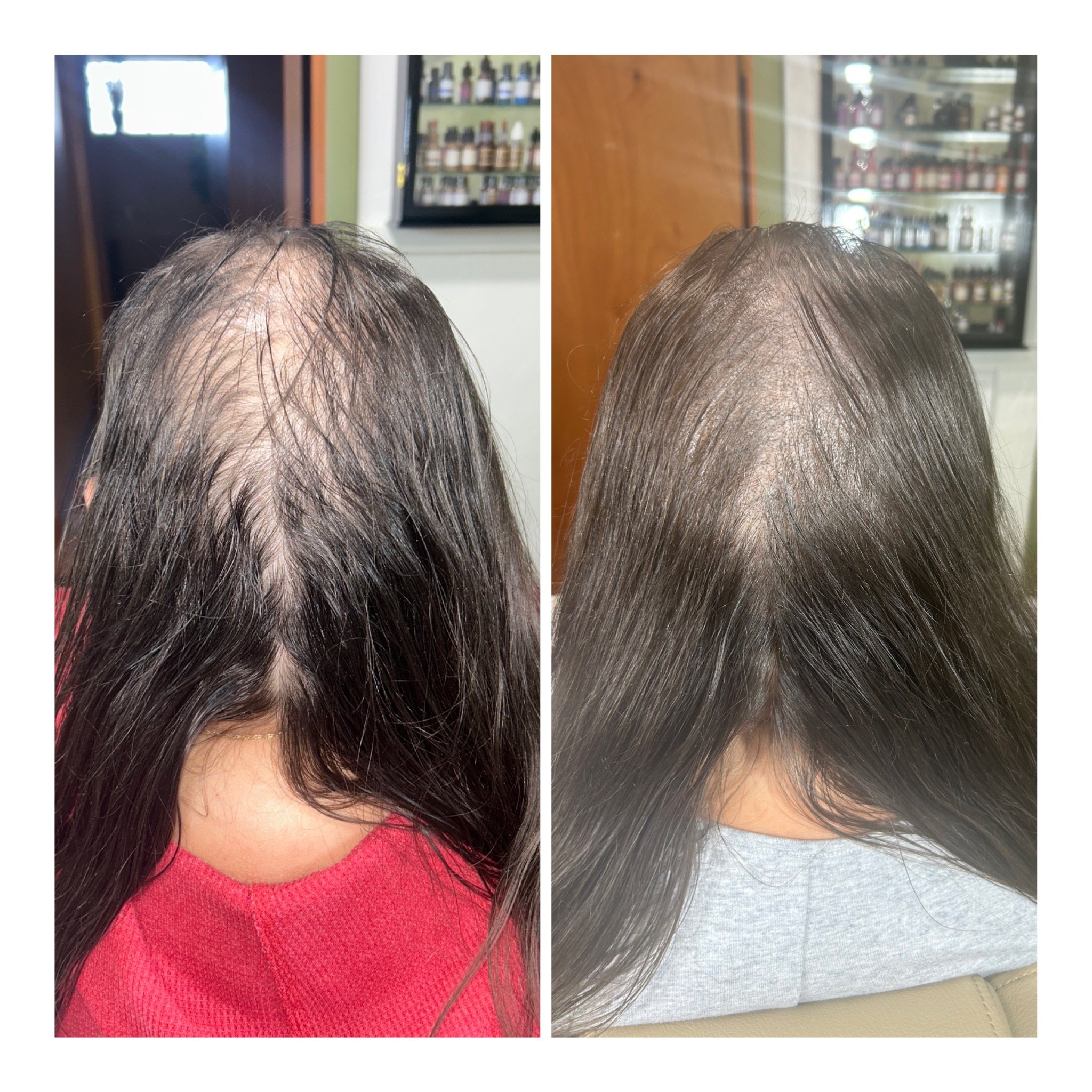 Before & After SMP (Scalp Micropigmentation