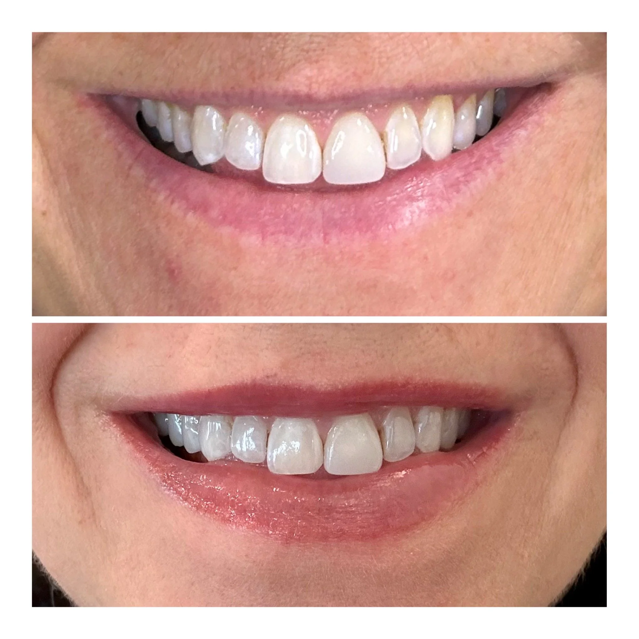 Lips Before and Healed results 