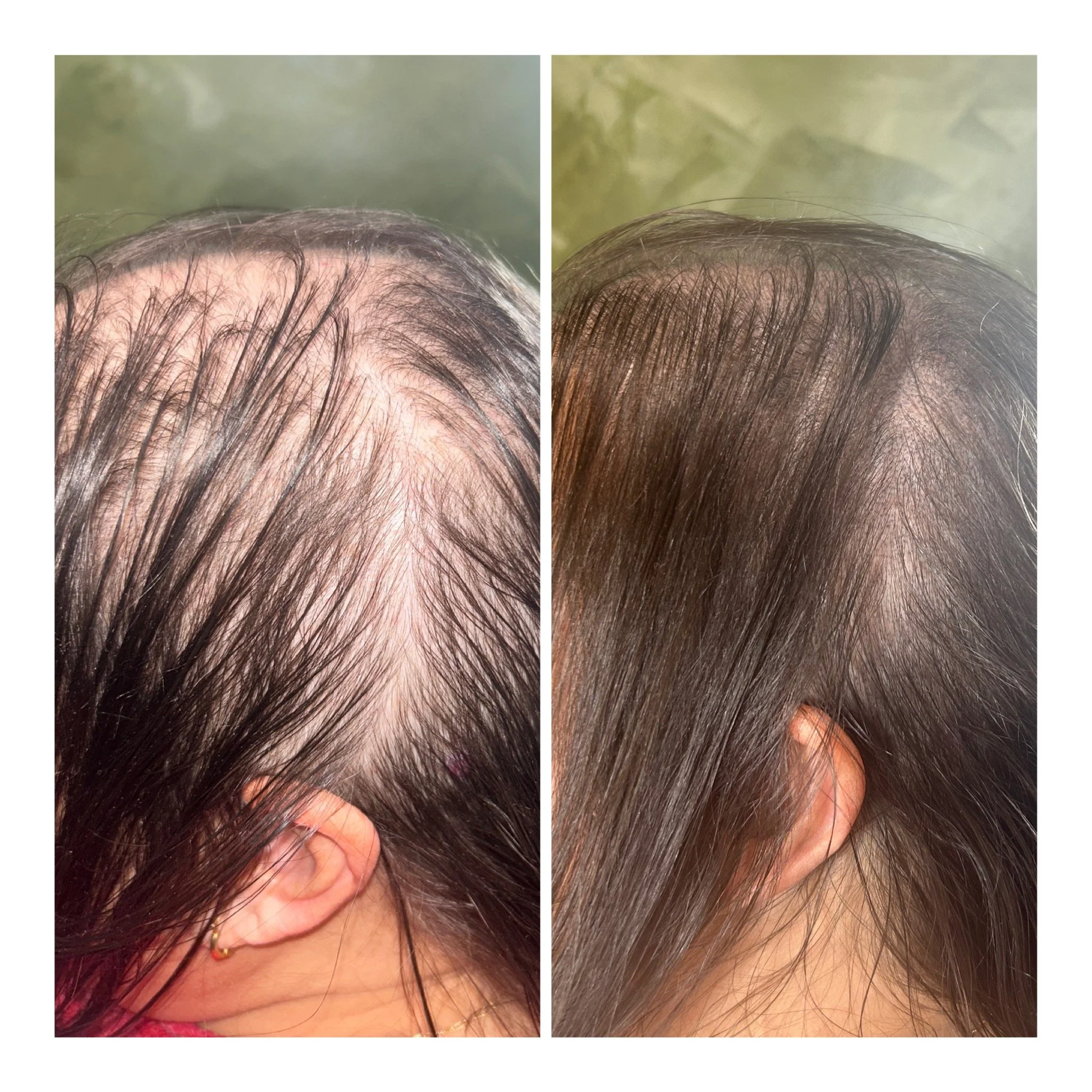 Before & After SMP (scalp micropigmentation