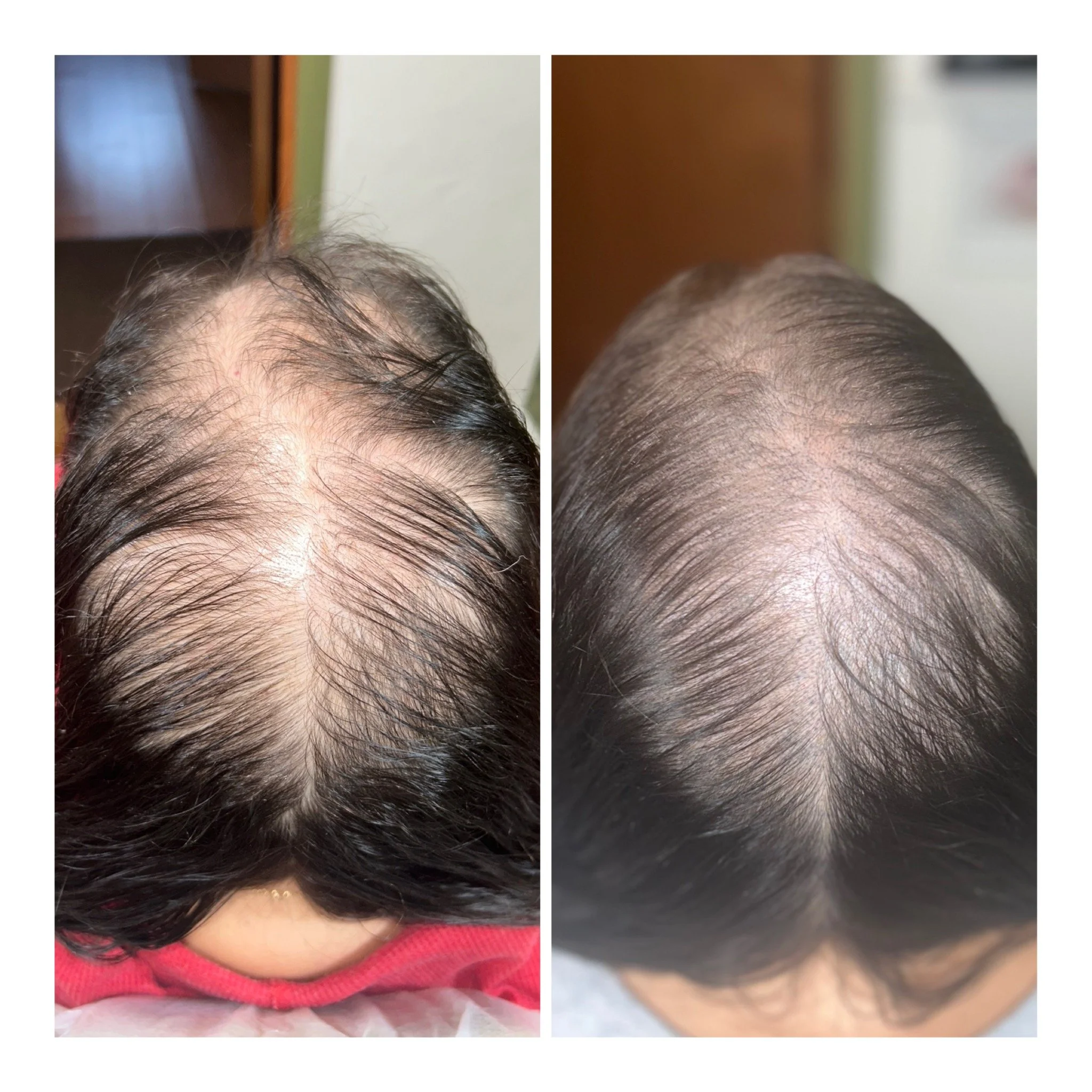 Before & After SMP Scalp Mircopigmentation