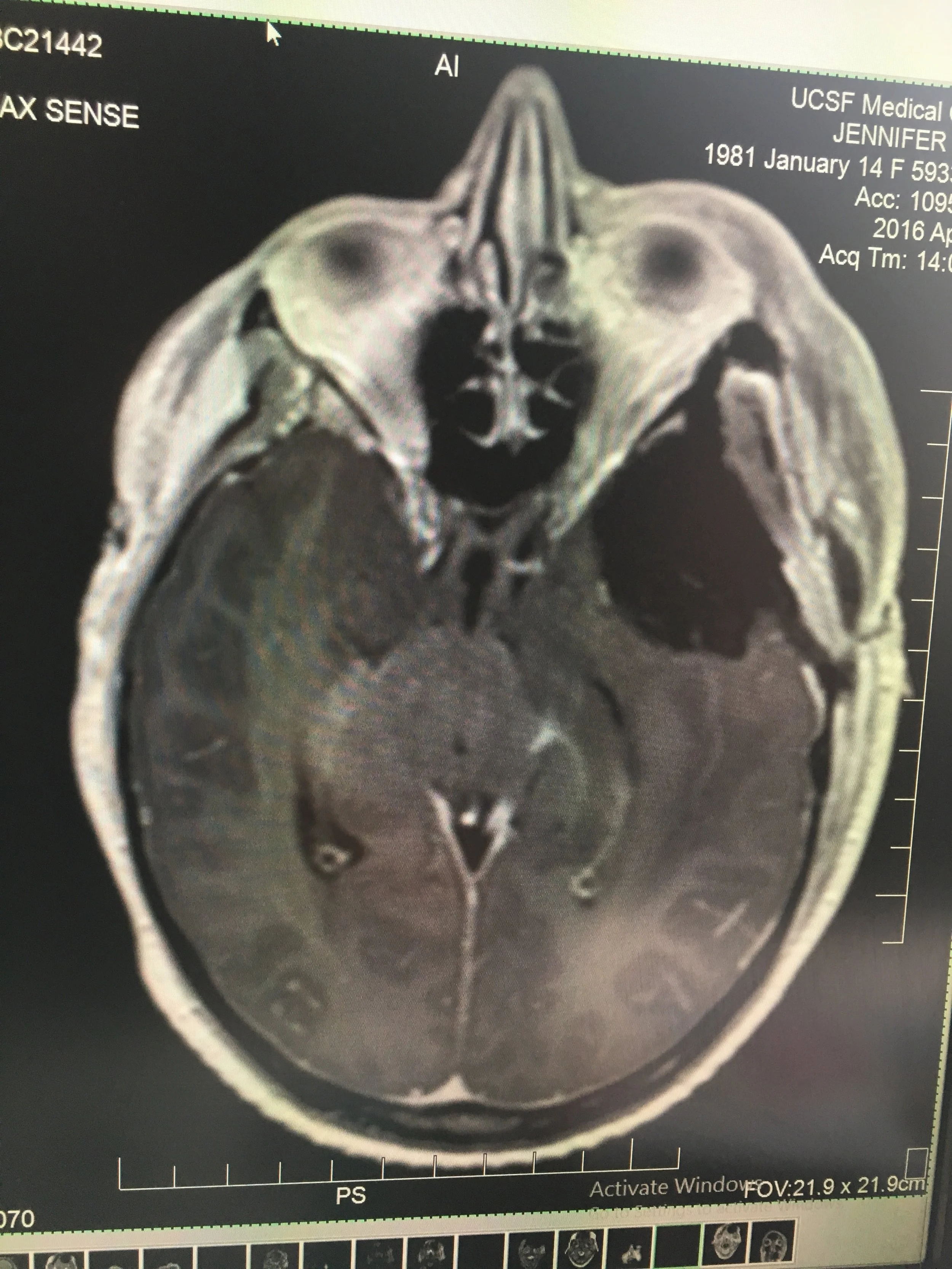 Can you see the empty space where the tumor had been?