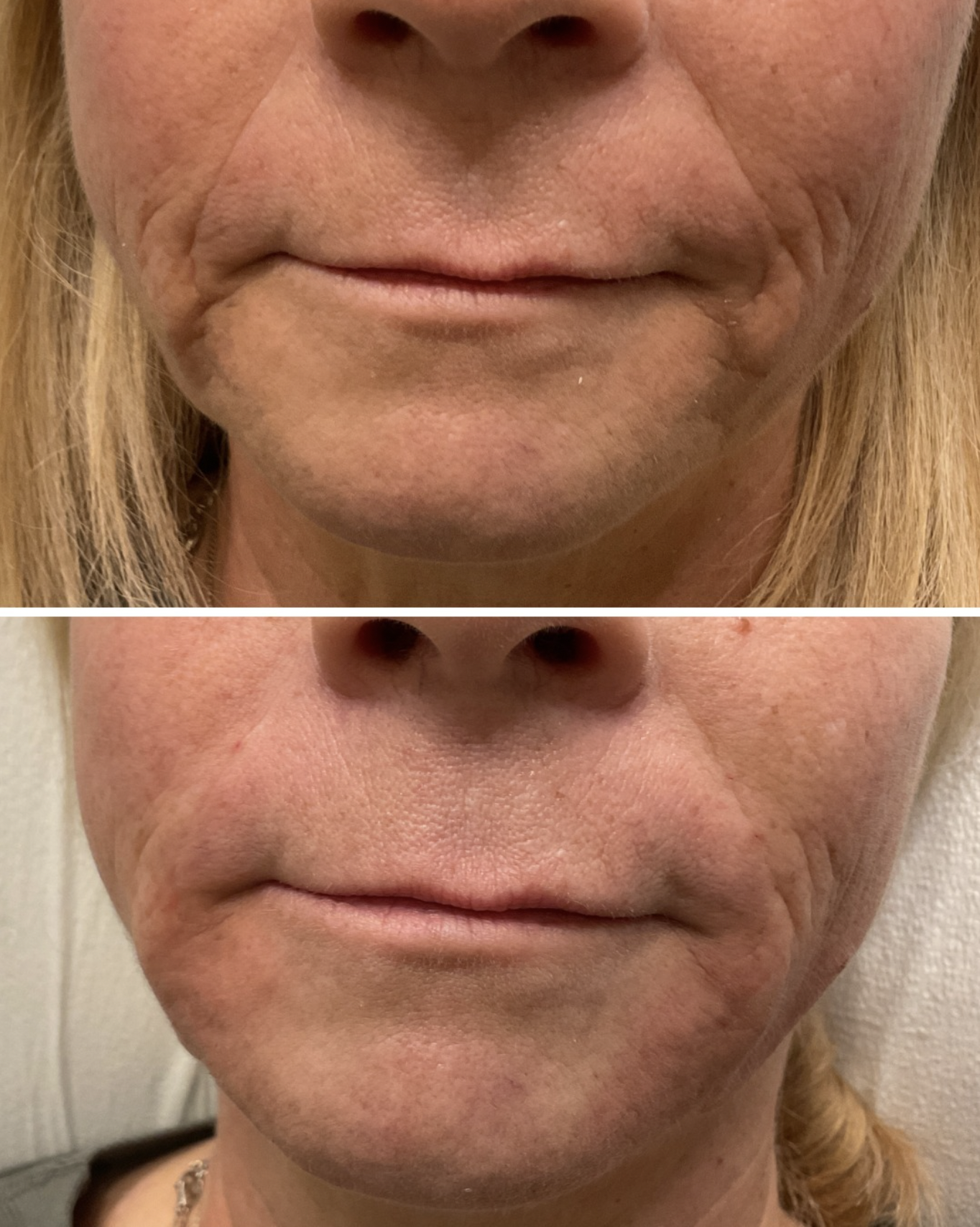 Fillers Can Deliver Natural Results