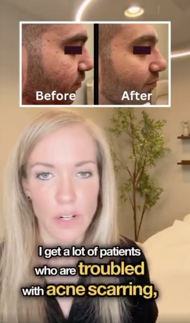 Say Goodbye to Acne Scars 