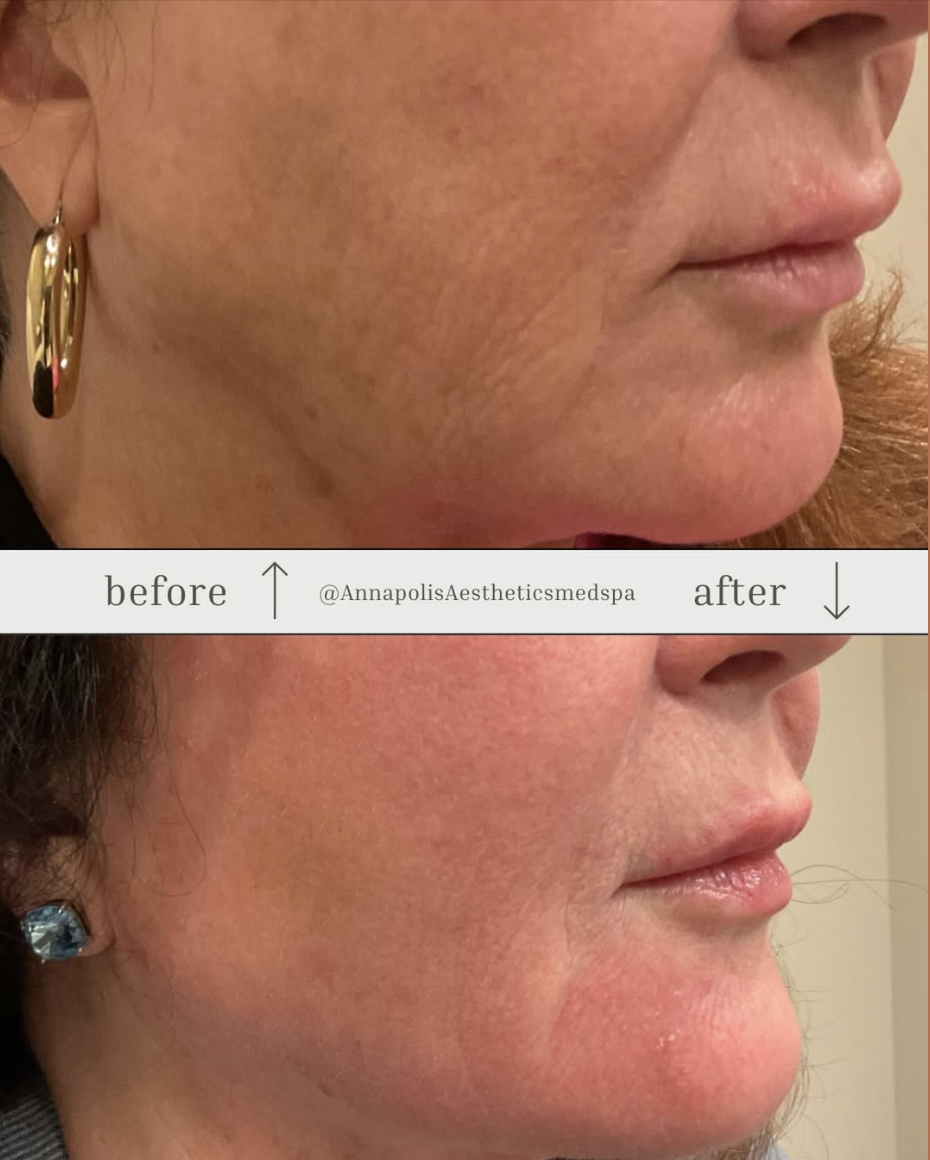 Halo Laser Before and After 
