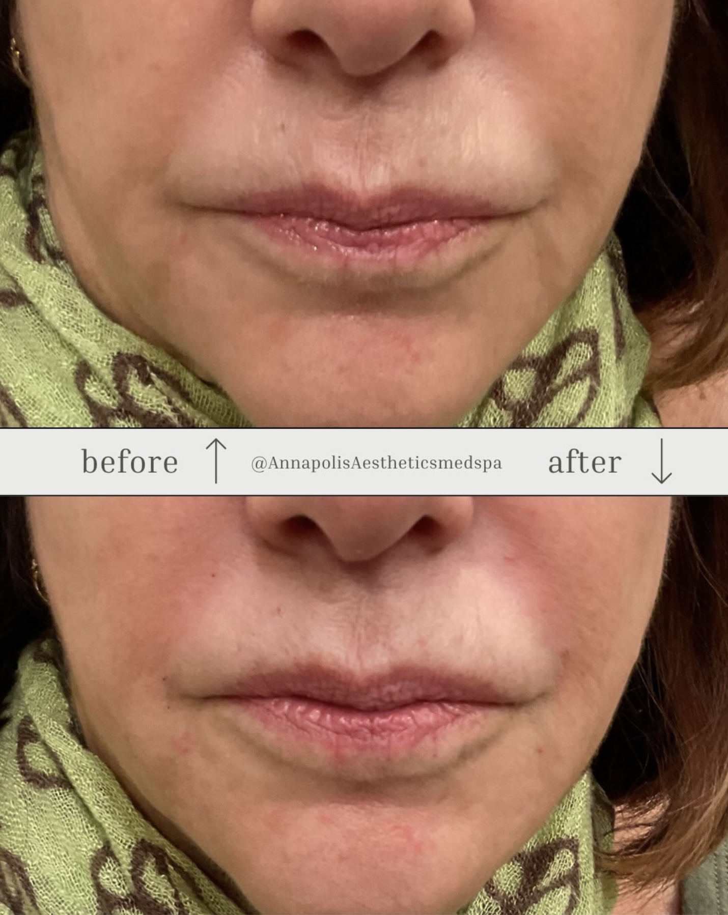 Filler Before and After 