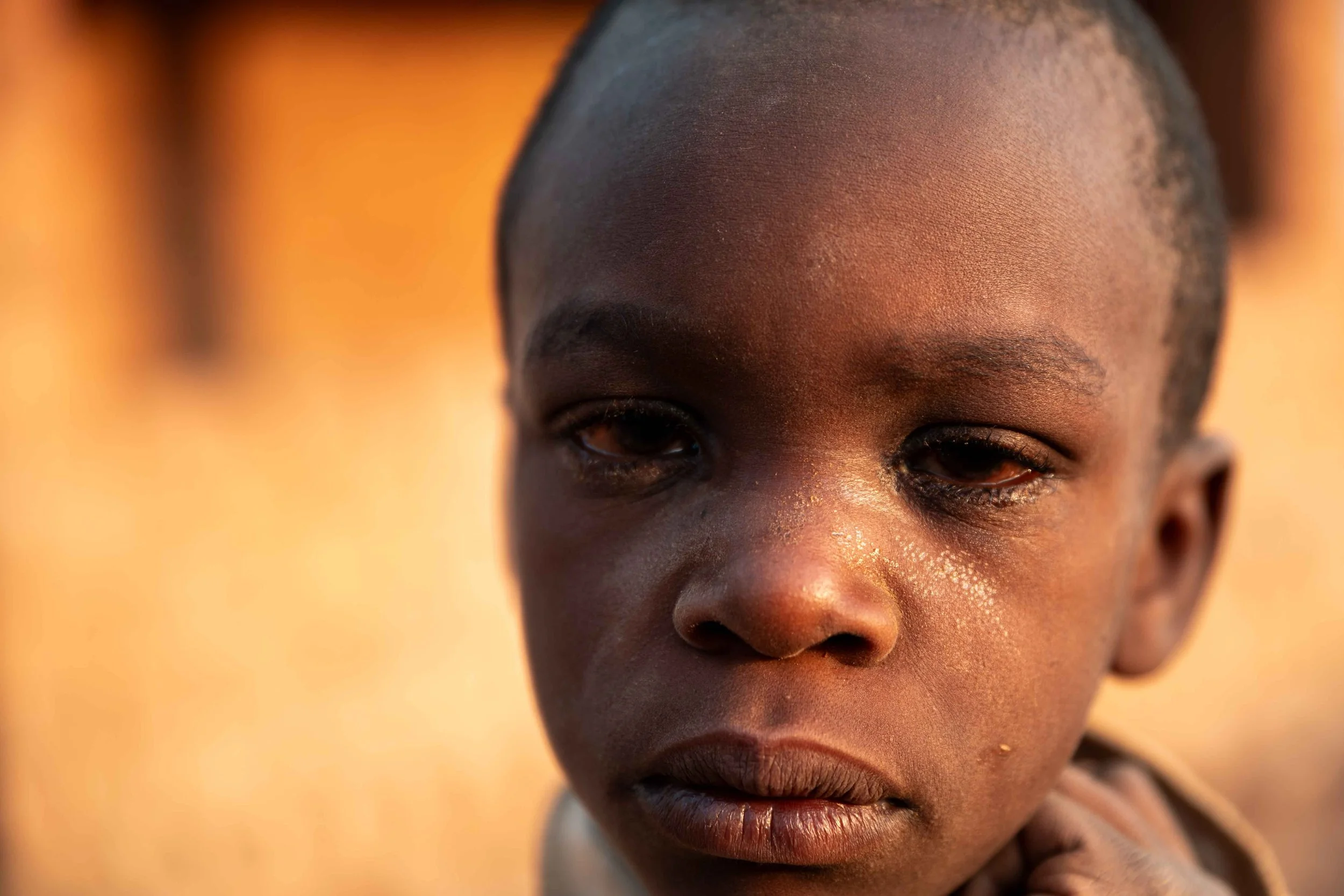 Portrait of Ephraïm Mutamba, 7, suffering from an illness causing eye redness. Fungurume, Lualaba Province, Democratic Republic of the Congo.