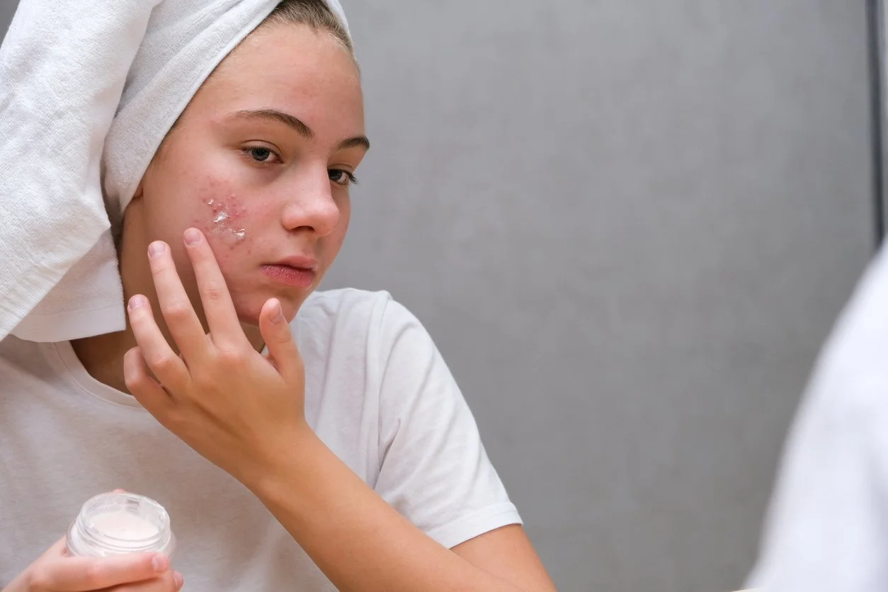 Clearer Skin Starts with Personalized Acne Care