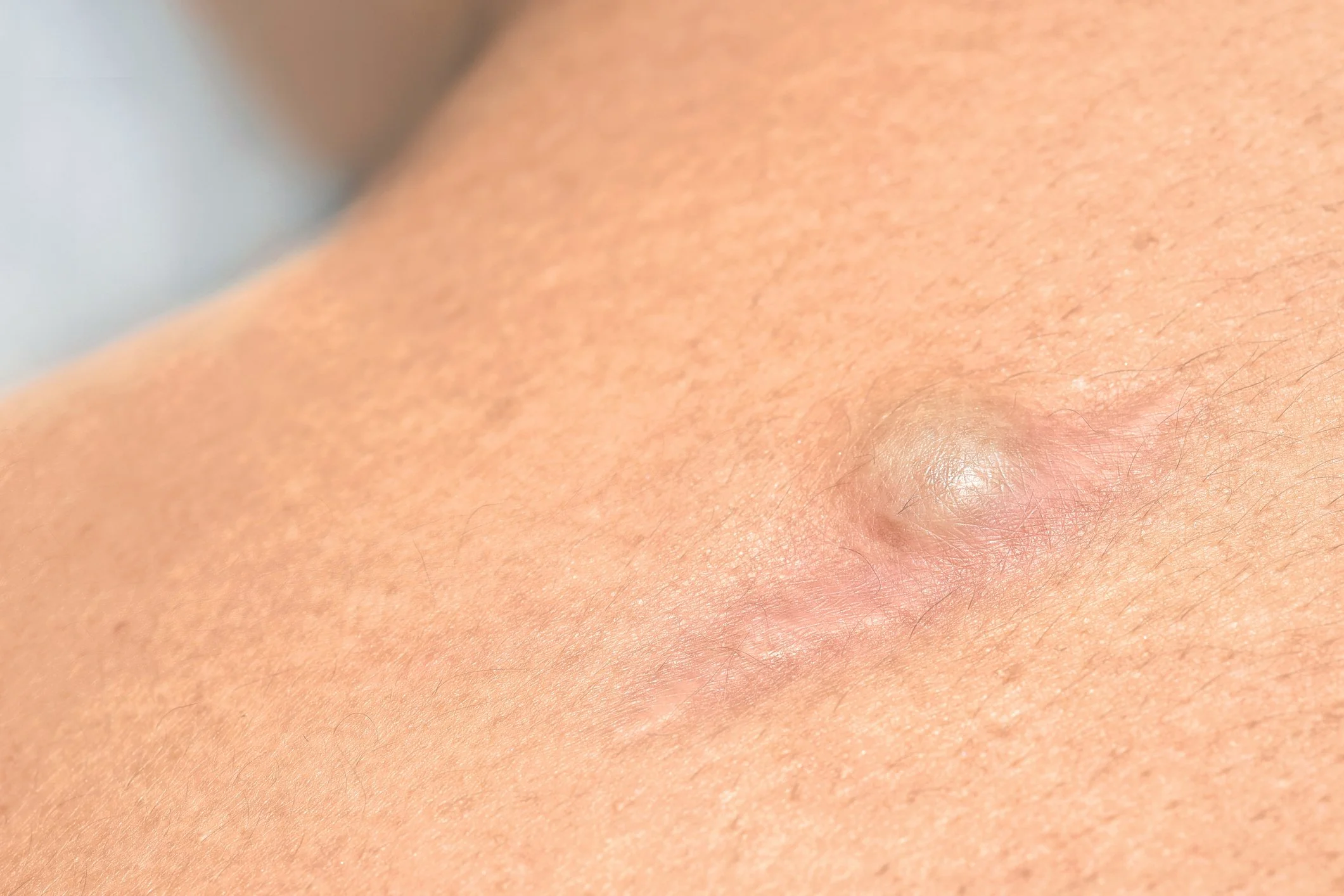 Have a Lump or Bump? Your Dermatologist Can Help