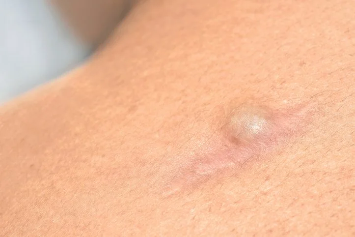 Have a Lump or Bump? Your Dermatologist Can Help