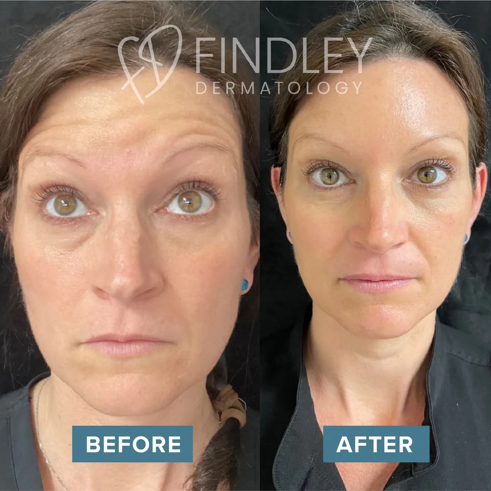 How Much Botox Do You Need for Your First Treatment?