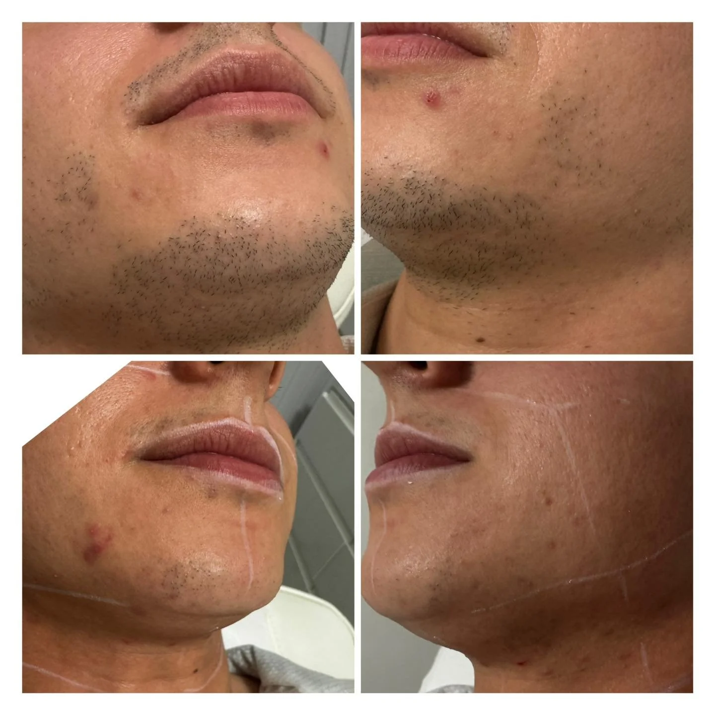 How it’s started vias how it is going πππ
Tired of daily shaving, ingrown hairs, or irritation on your beard line? Laser hair removal isn’t just for smooth skin – it’s also a smart solution for men who want:
β
A cleaner,