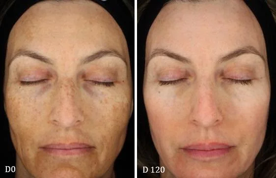Struggling with pigmentation? Let’s talk science + solutions!
Pigmentation concerns like dark spots, uneven tone, and melasma are often linked to tyrosinase, an enzyme that controls melanin production in the skin. When tyrosinase activity inc