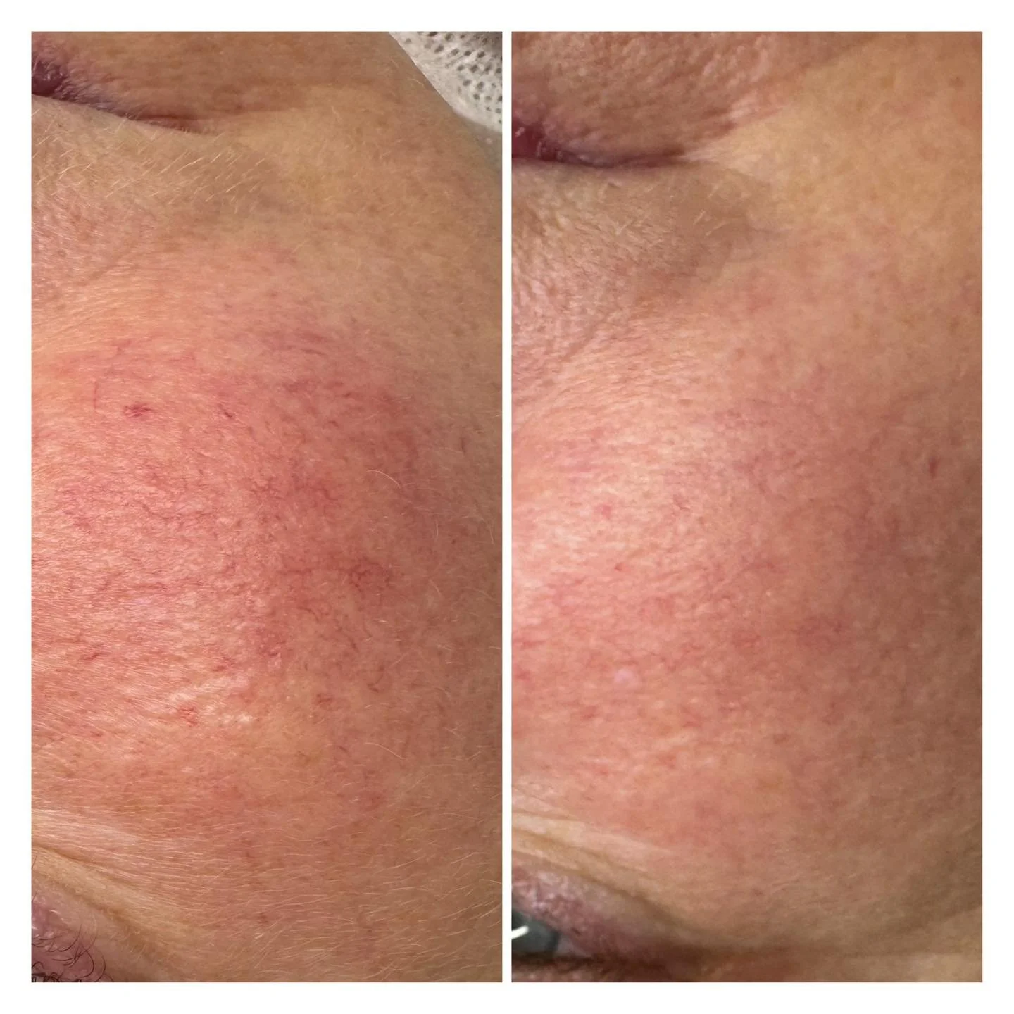 Laser Skin Rejuvenation – overview and results
Indications
• Rosacea (redness, flushing, visible blood vessels)
• Sun damage / photoaging (pigmentation, uneven tone, texture)
• Capillaries / thread veins (broken or dilated v