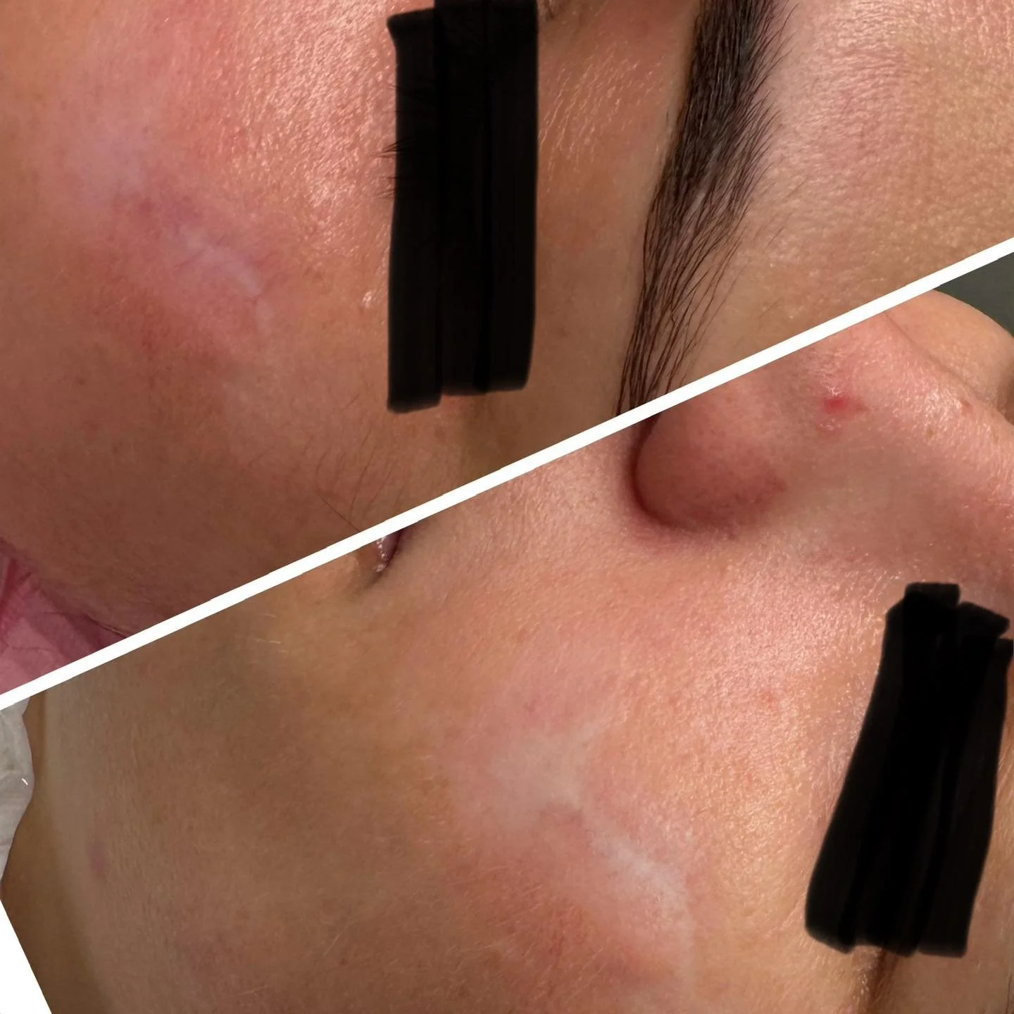 RF Microneedling: Results Worth the Wait
When it comes to advanced skin treatments, patience truly pays off!
RF Microneedling works by creating controlled micro-injuries in the skin, combined with radiofrequency energy. This triggers your body&rs