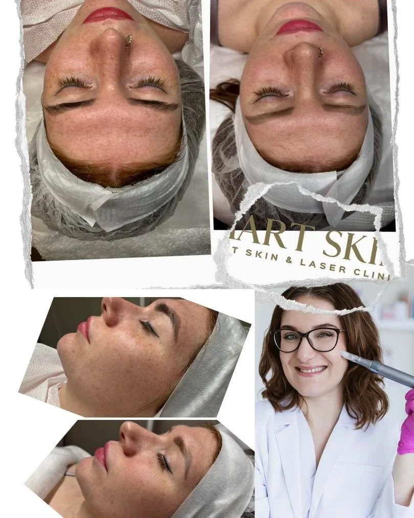 Microneedling. Real skin transformation. 

Amazing results from microneedling 
✔ Improved skin clarity
✔ Smaller-looking pores
✔ Reduced hyperpigmentation
✔ Less redness and inflammation
✔ Fewer comedones &amp; congestion
✔ Plumper, healthier-looking