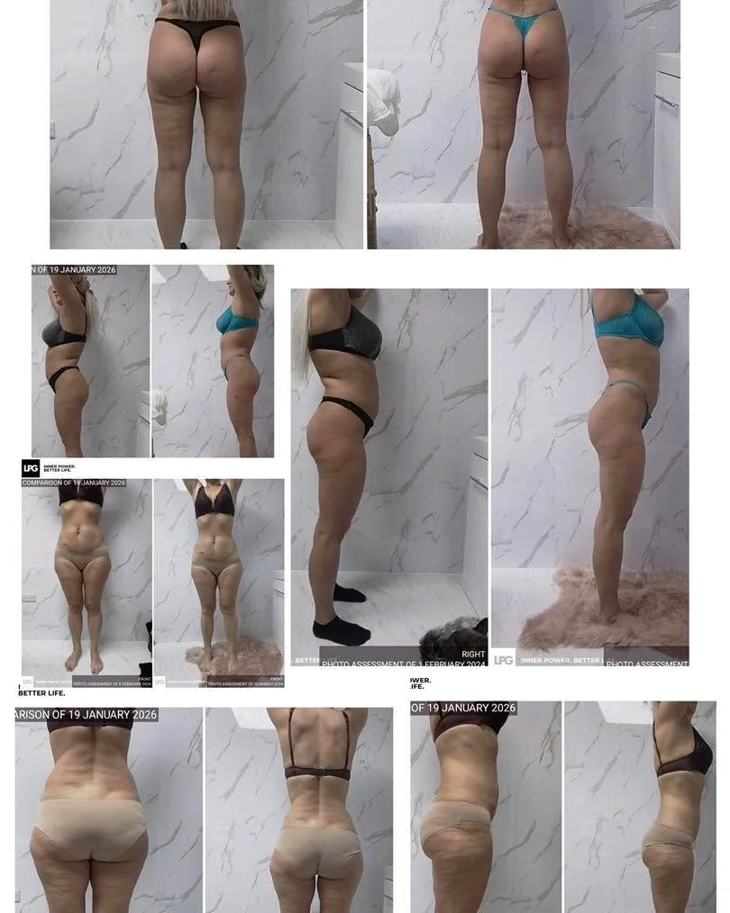 Two clients. Amazing results. One powerful treatment. 

Our LPG body treatments are delivering visible results &mdash; smoother skin, improved contour, and boosted confidence 

What is LPG?
LPG (Endermologie&reg;) is a non-invasive body treatment tha