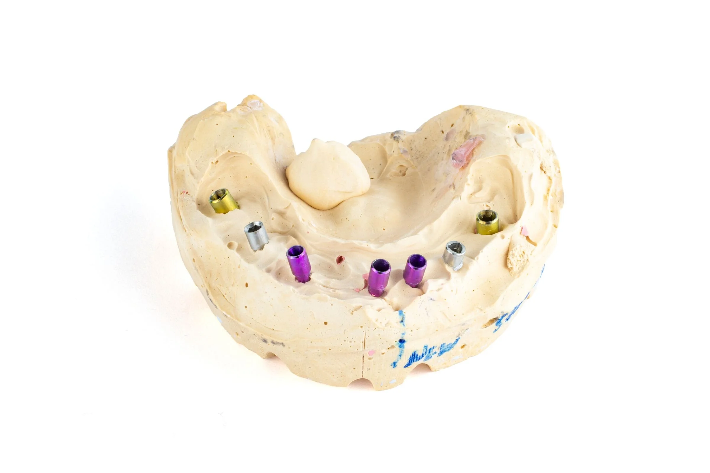 aa 210129-anatomical-bridge-front-analogs.jpg