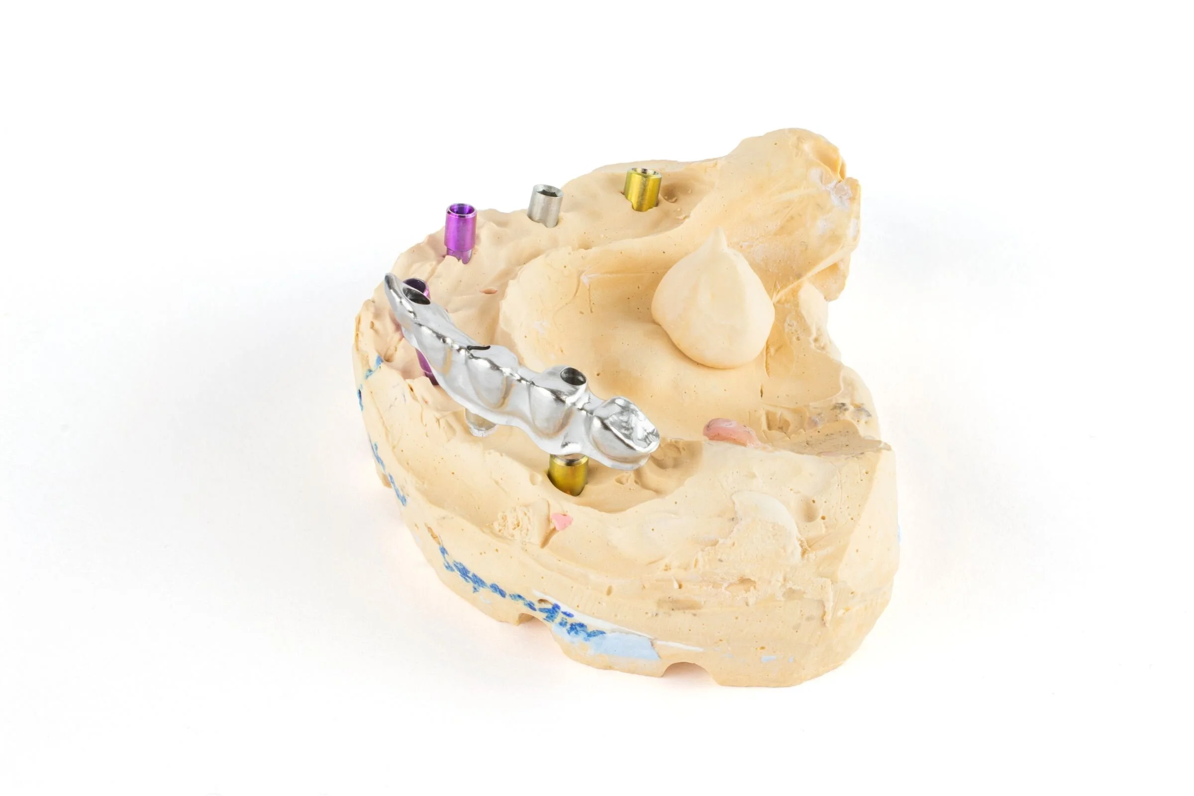 aca 210129-anatomical-bridge-left-a.jpg