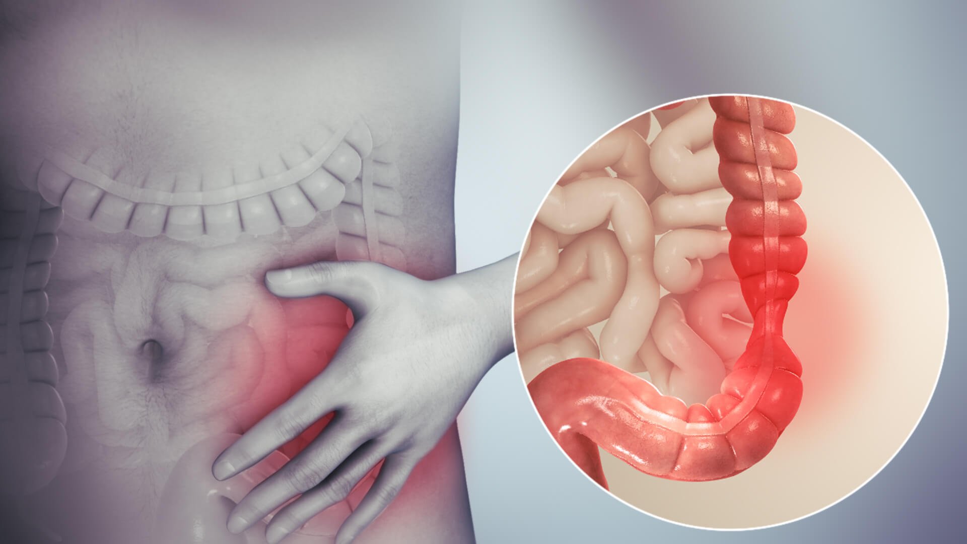 3 Proven Strategies to Overcome IBS