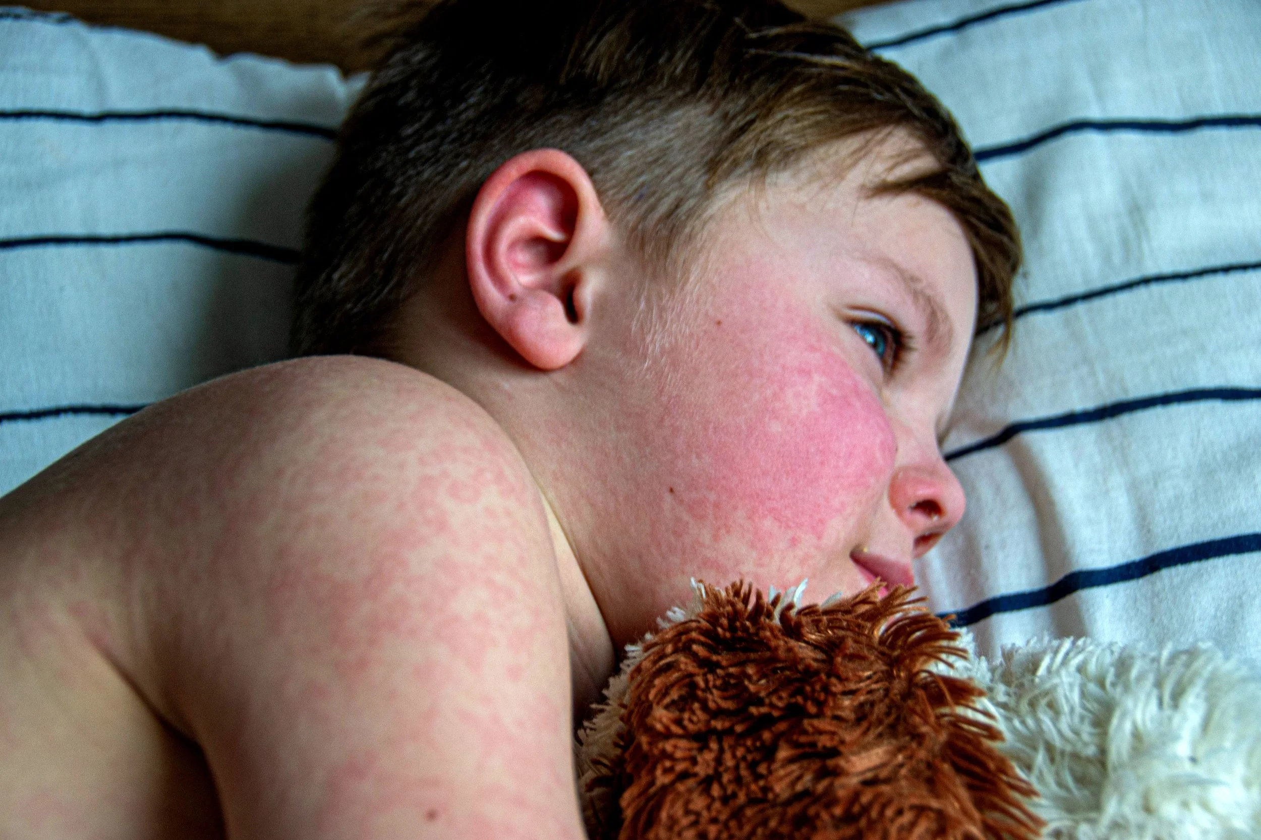 A young boy with red cheeks and light brown hair lying on a striped pillow, holding a brown and white stuffed animal close to his face.