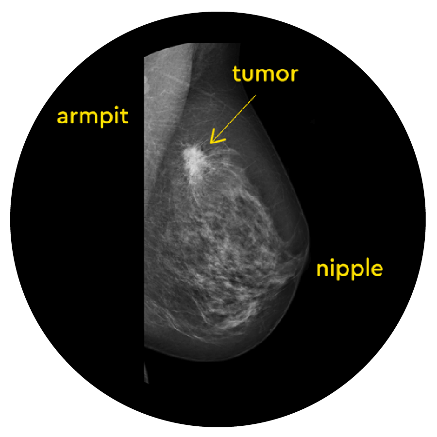 What Is A Mammogram And When To Get A Mammogram Know Your Lemons For what-is-a-mammogram-and-when-to-get-a-mammogram-know-your-lemons-for