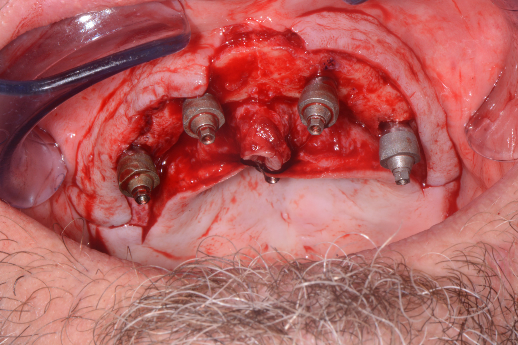 fi3ld suture cap 1.png