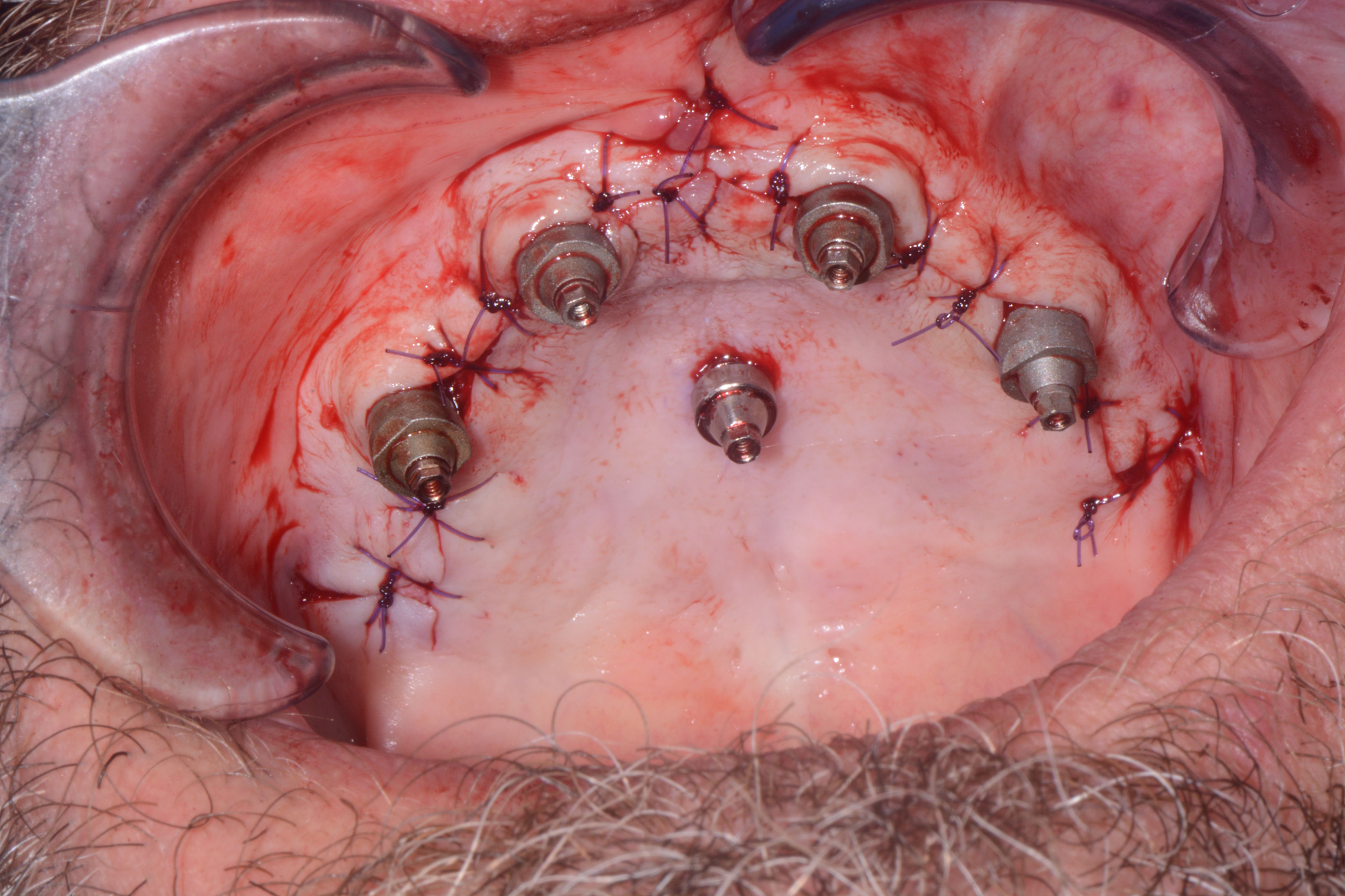 fi3ld suture cap 2.png
