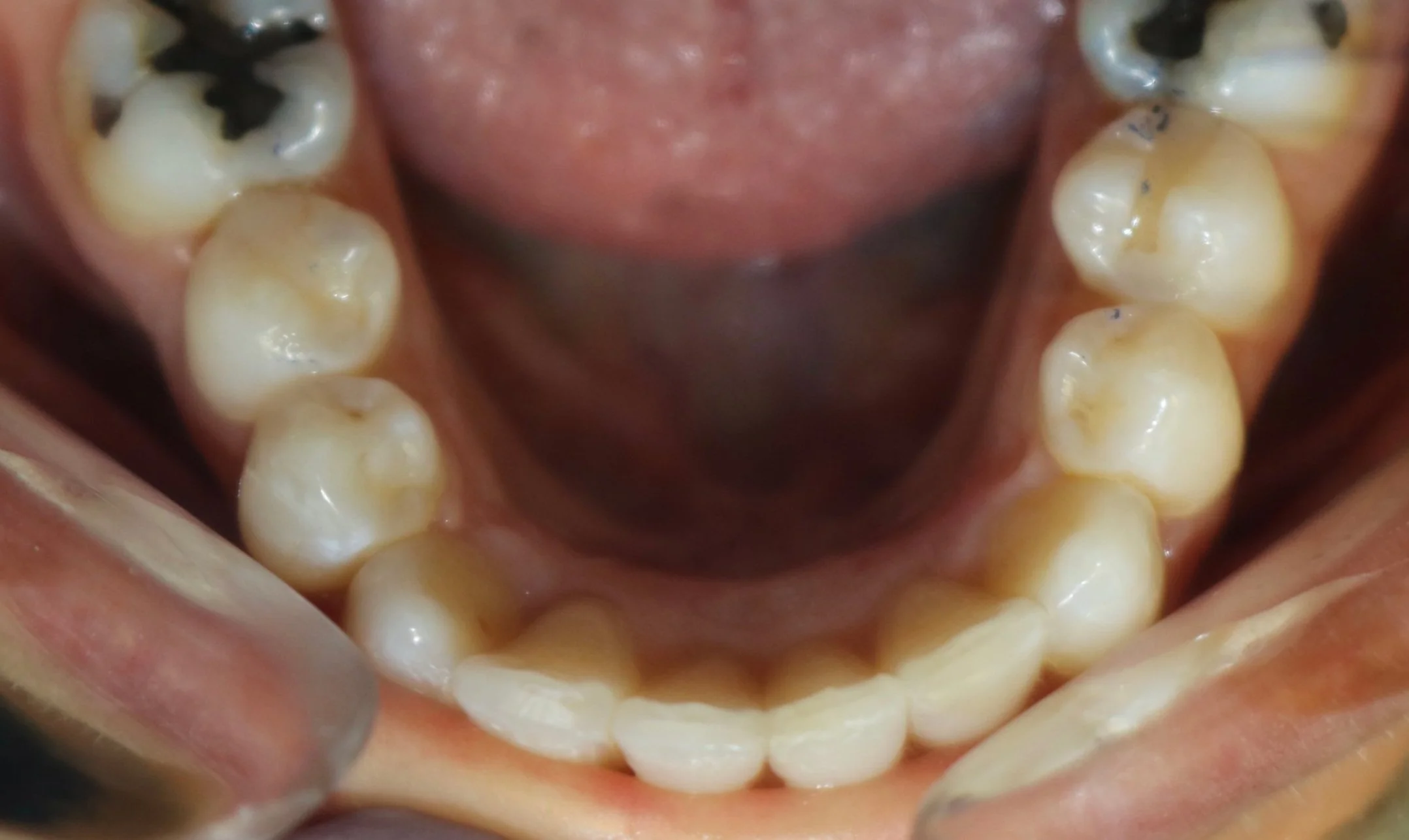 AFTER: Invisalign completed in 9 months to broaden smile and correct crowding