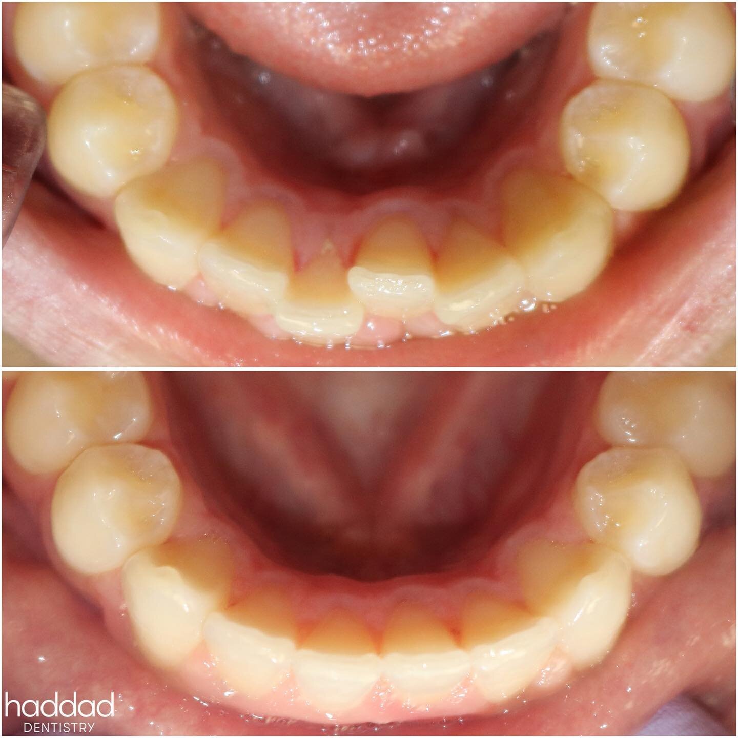 🙌 Line &lsquo;Em Up! 🙌

This young adult was able to resolve his #crowding in 6 months with @revealclearaligners! The best part? No shaving of his #teeth and no bonded attachments needed! Another great improvement to notice is how healthy his inner