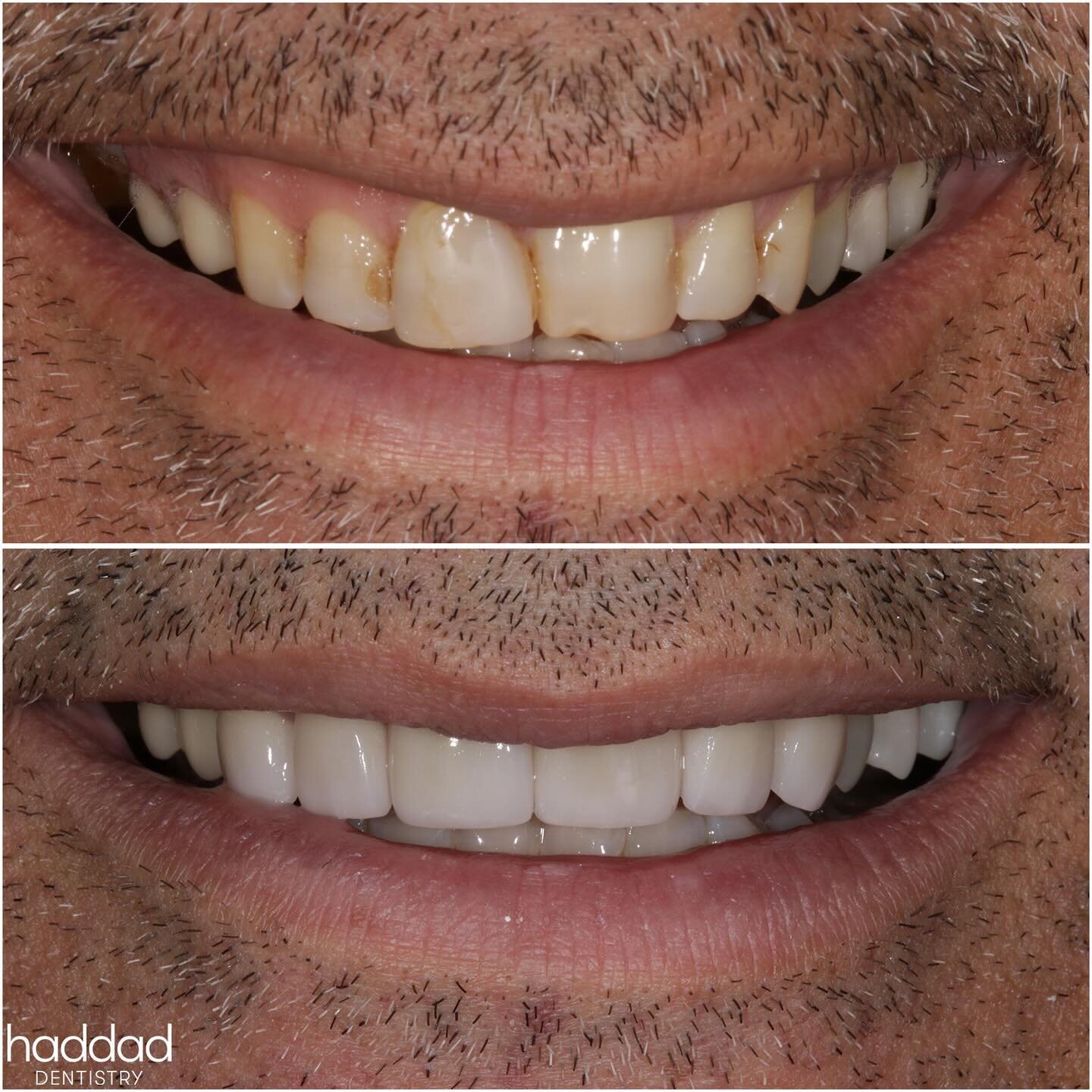 Ready for the Cameras!⭐️📸

A #beforeandafter for a charming #smile! This case was not only fulfilling with the outcome, but the considerations needed to get there. This patient has &ldquo;gemination&rdquo; of his front left central #incisor: the bud