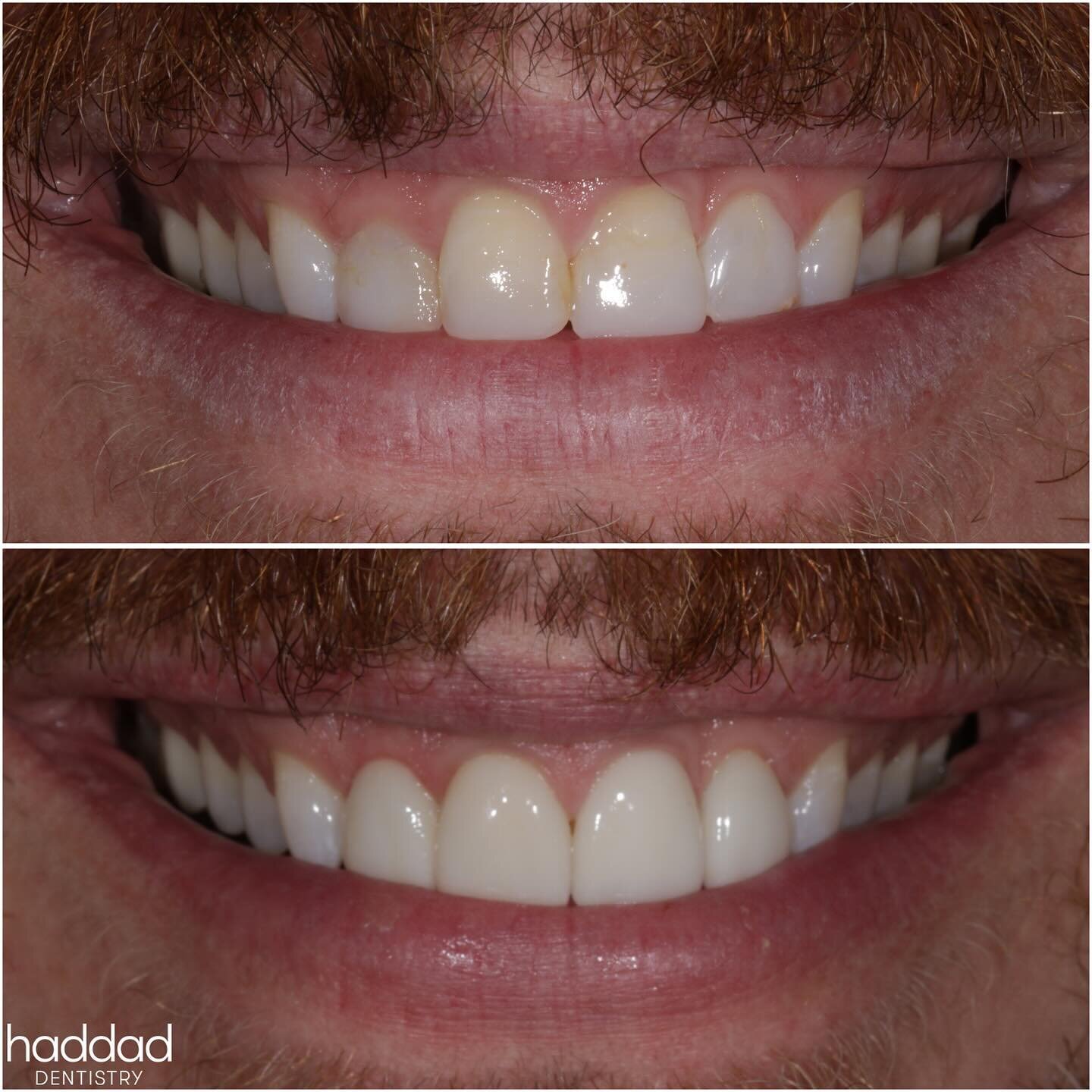 🌟Front and Center🌟

New #emax #veneers for this patient&rsquo;s front four #teeth!

Previous bondings were chipping and staining, and after completing #clearaligner treatment, it was the right time to focus on an improved #esthetic solution with th