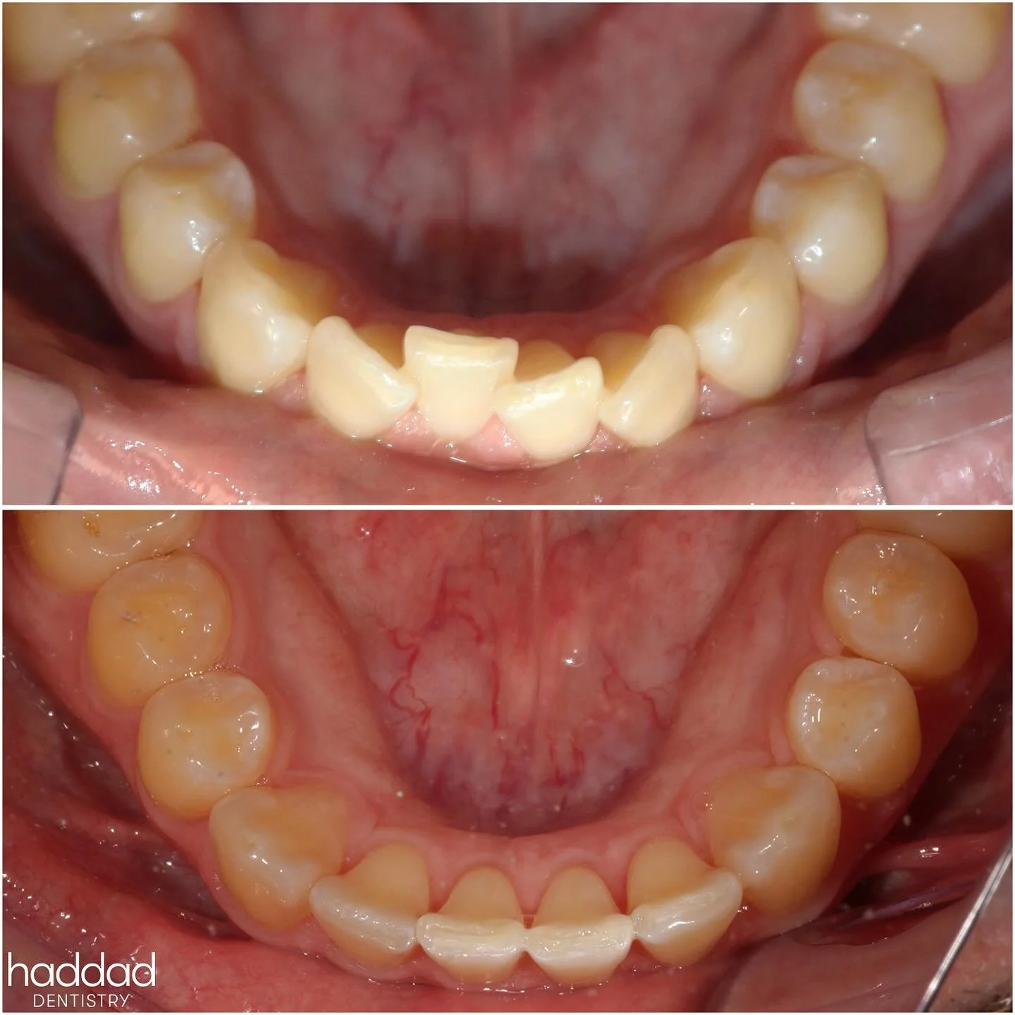 ✨Your Teeth, But Better✨

Check out these fantastic results our patient achieved with only 8 MONTHS of @clearcorrect aligners!

He had signifant #crowding of his lower incisors and an upper front tooth that always felt shadowed and blocked out when s