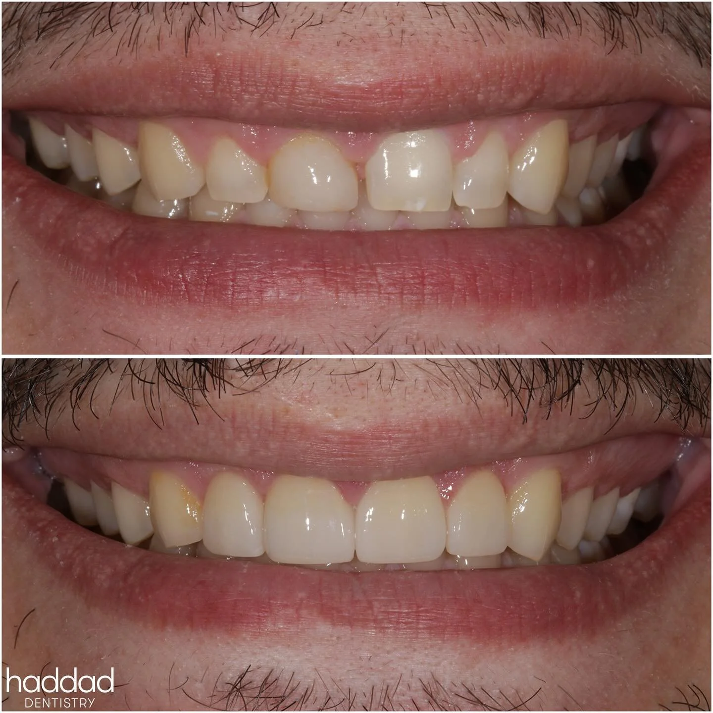 It was a great privilege to help a childhood friend achieve his #smile goals this last month! 

Having some spacing, smaller and flatter teeth anatomy, and a previous trauma to his front tooth (skateboarder 🤙), our friend knew he was ready to make a