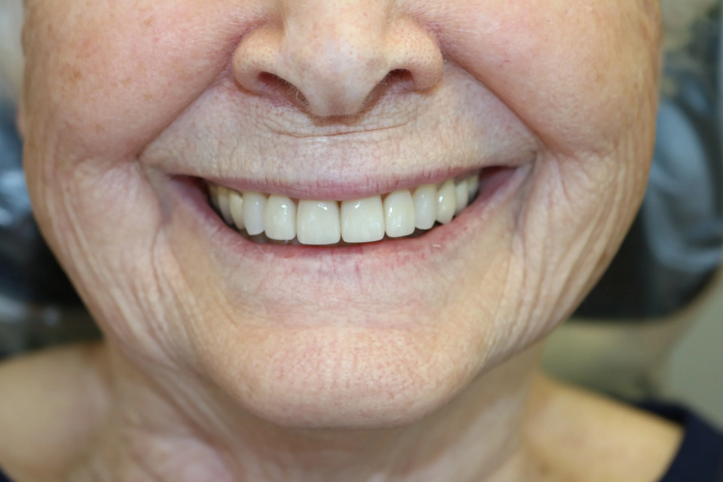 AFTER: porcelain crowns to correct damaged structure and restore youthful smile