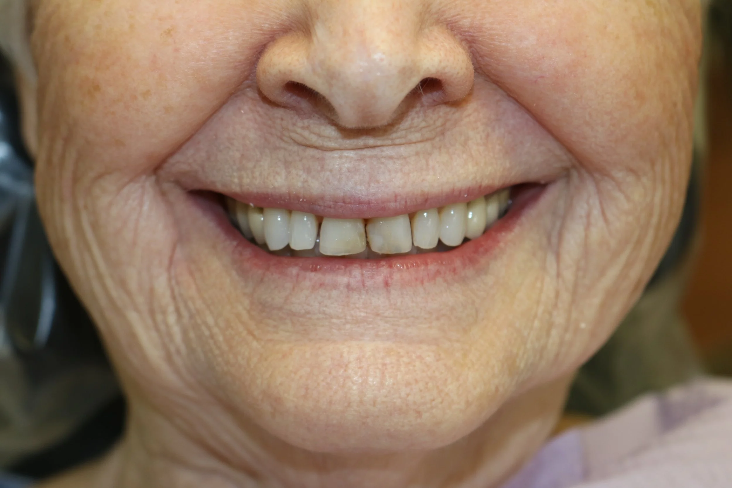 BEFORE: worn, spaced, aged front teeth