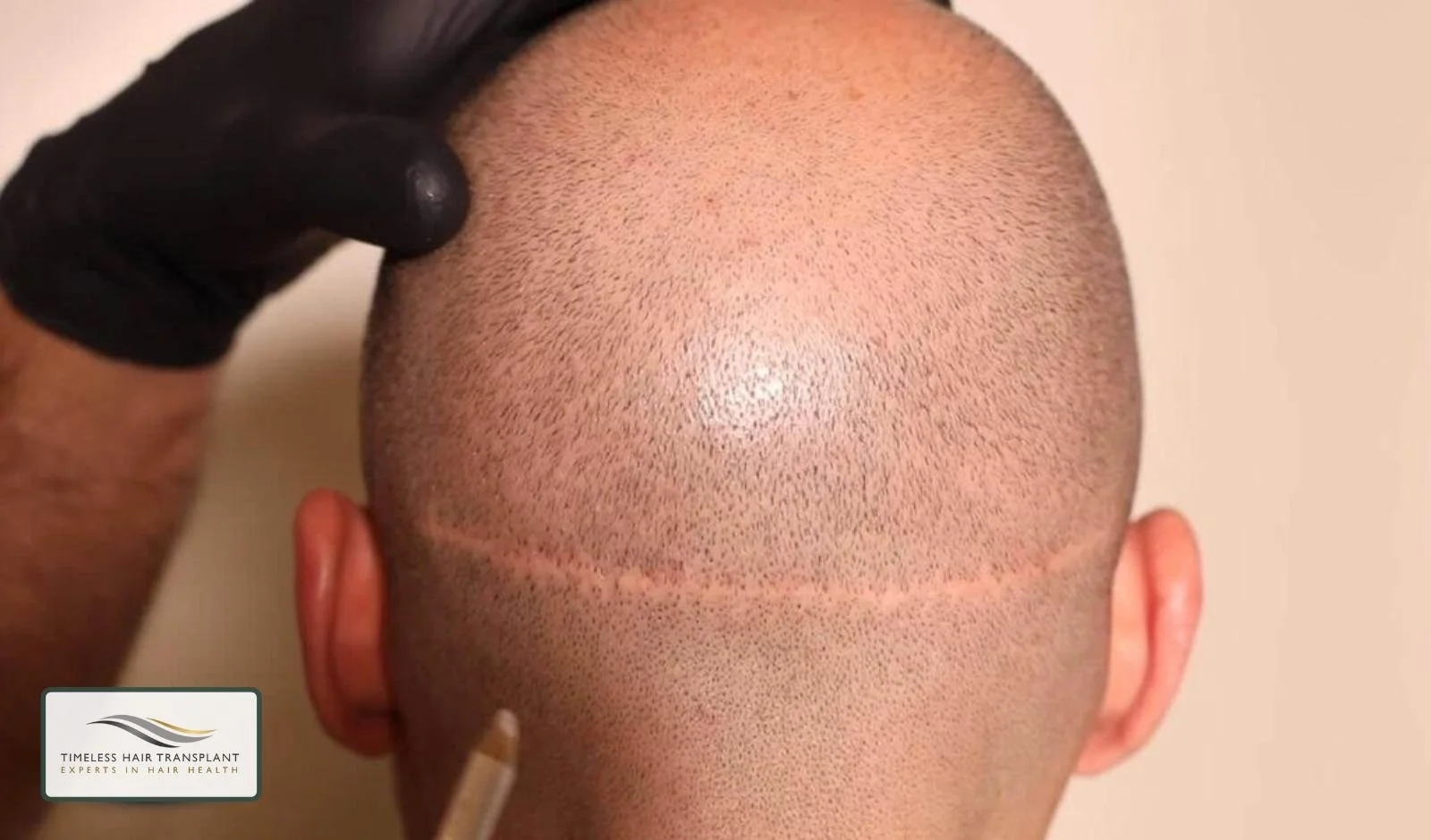 What Is FUT Hair Transplant
