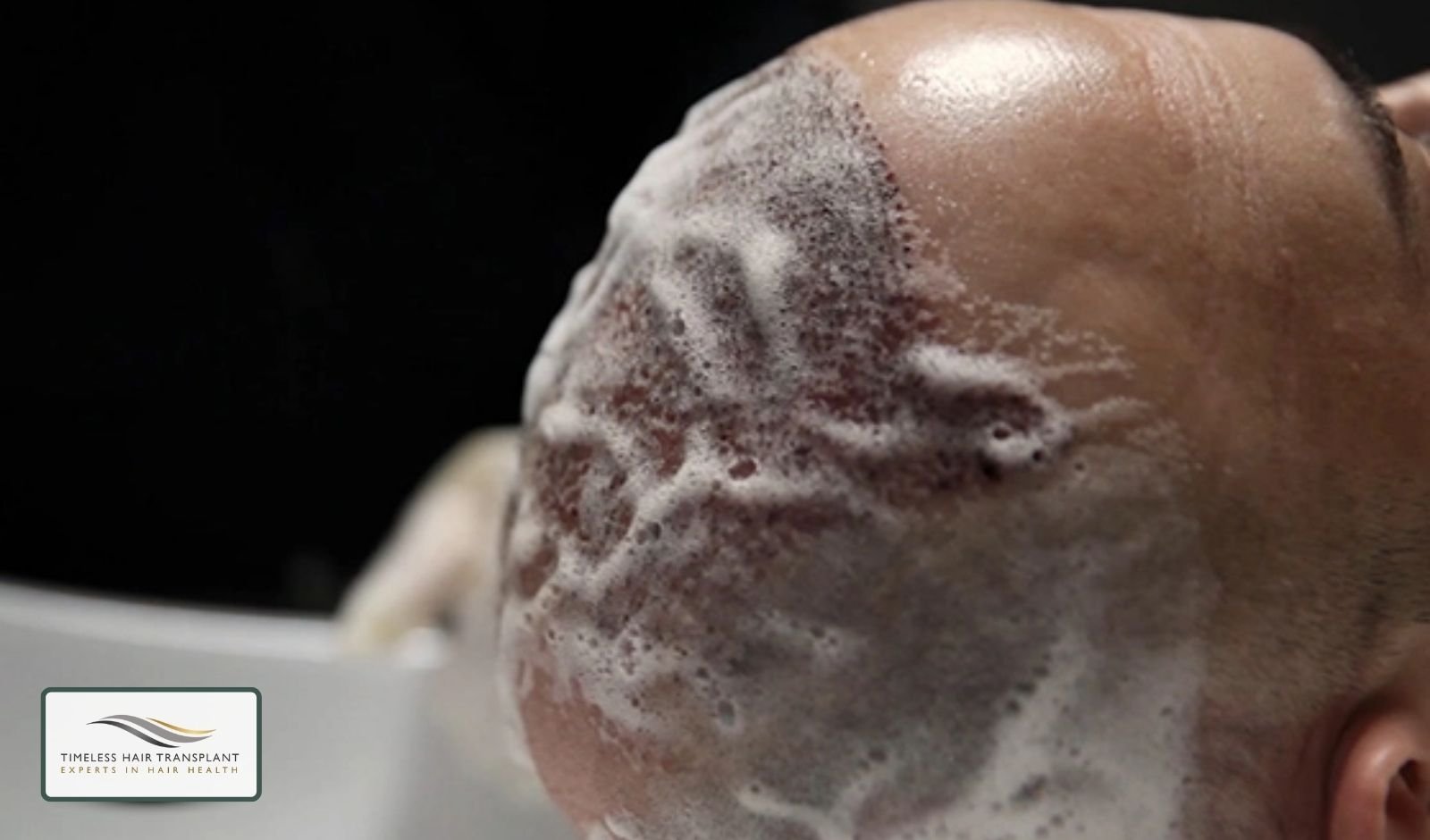 What Is the Best Shampoo After Hair Transplant Surgery