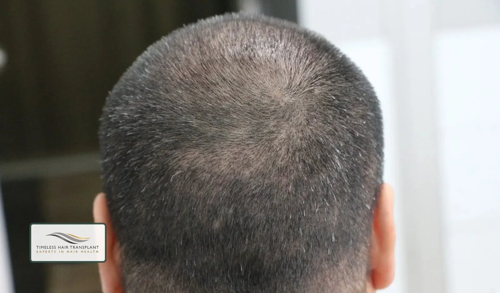 What About One Month After a Hair Transplant