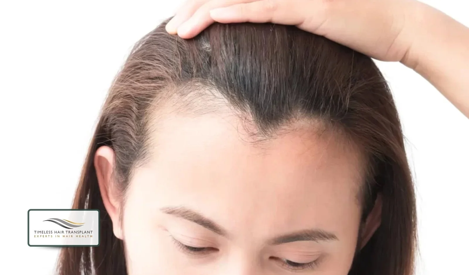 What Is a Receding Hairline in Women