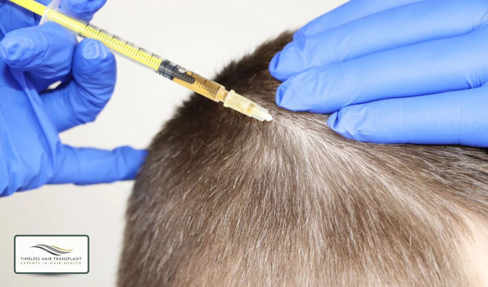 What Is Mesotherapy for Hair Loss