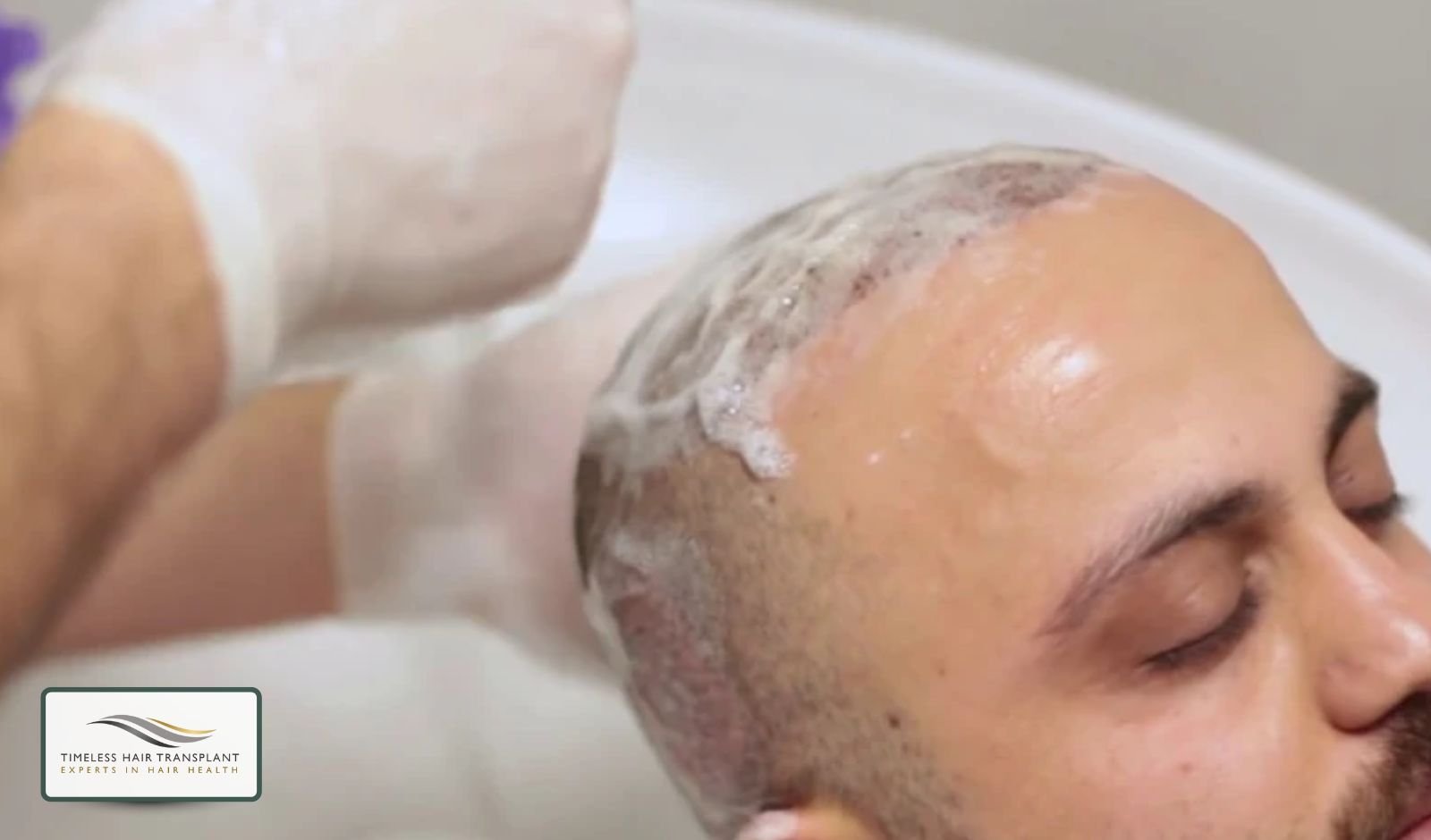 Why Washing Hair After a Hair Transplant Matters