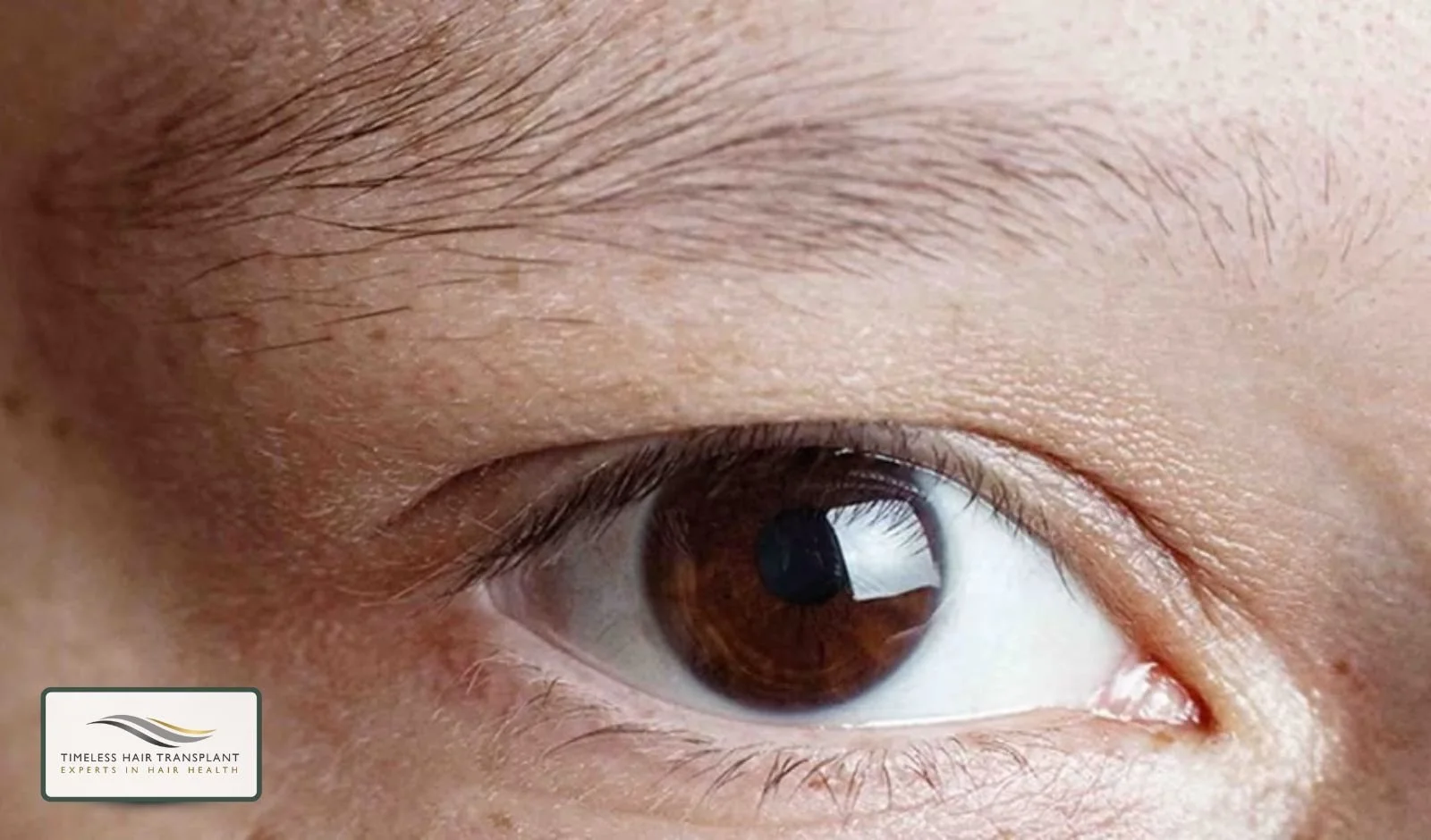 Understanding Eyebrow Hair Loss.