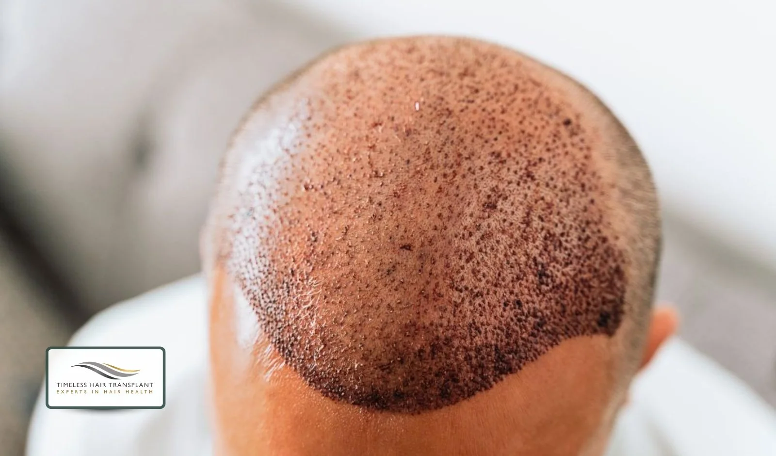 Why Your Scalp Itches After a Hair Transplant