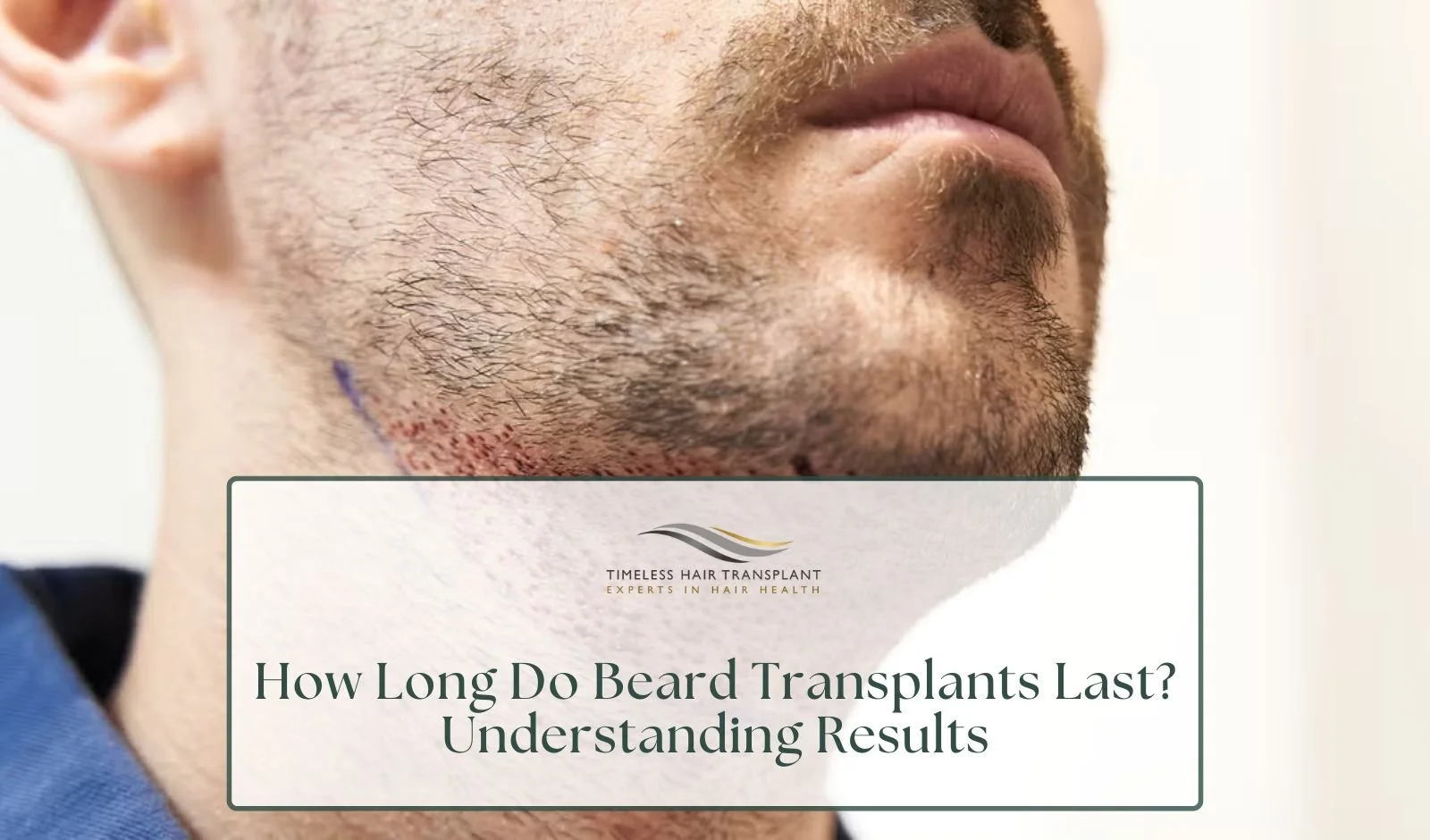 How Long Do Beard Transplants Last? Understanding Results