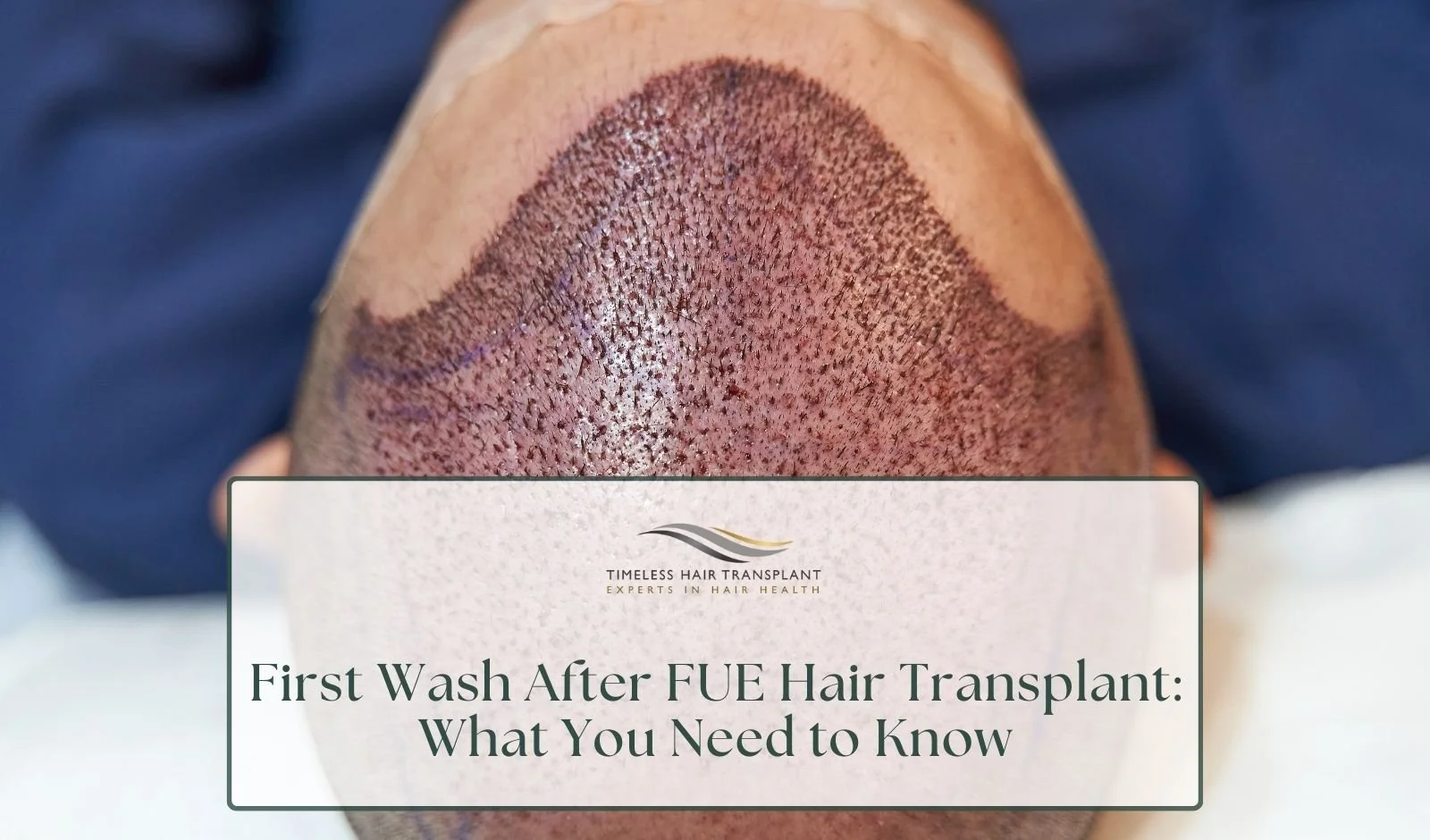 First Wash After FUE Hair Transplant: What You Need to Know